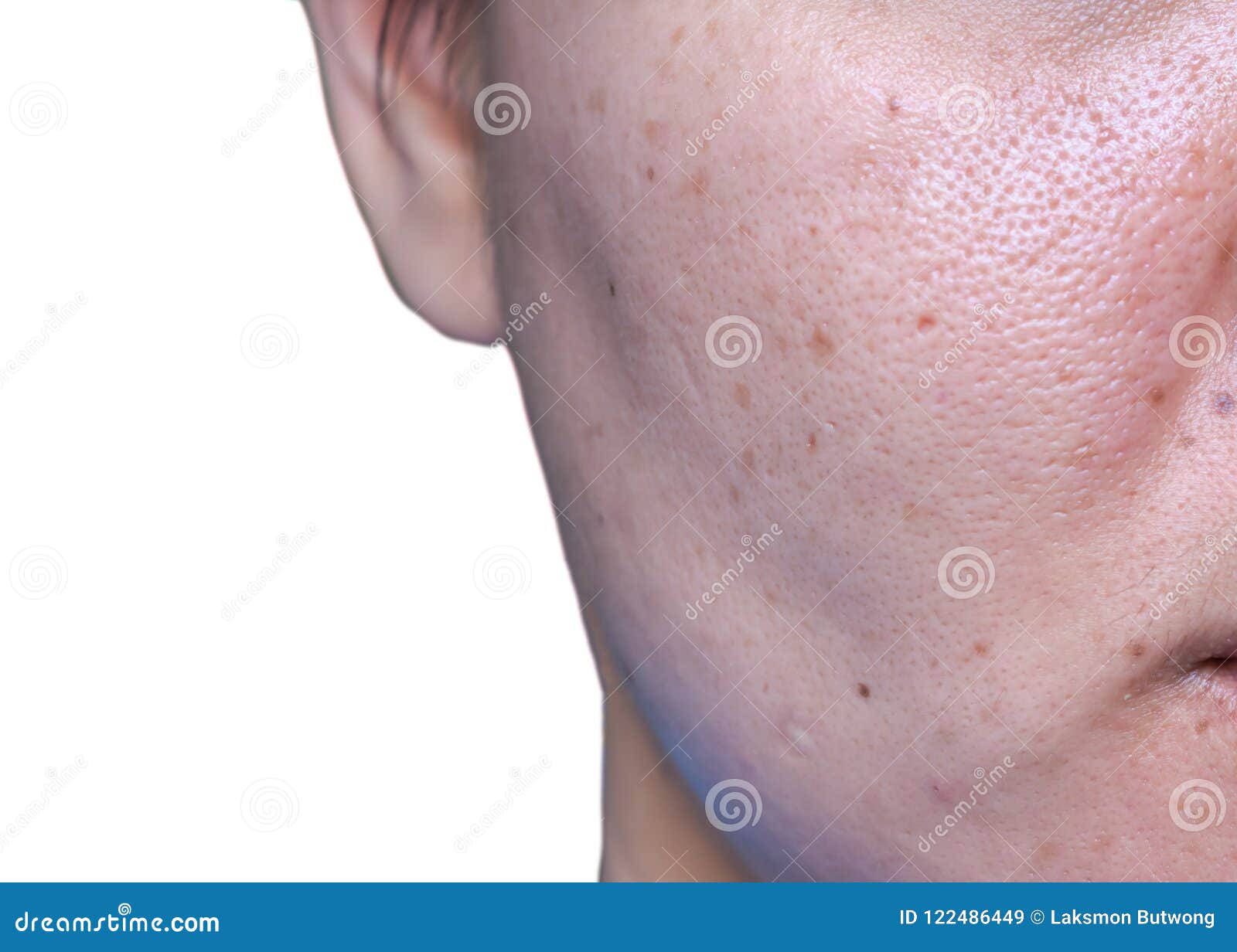 woman `s problematic skin , acne scars ,oily skin and pore, dark spots and blackhead and whitehead on the face