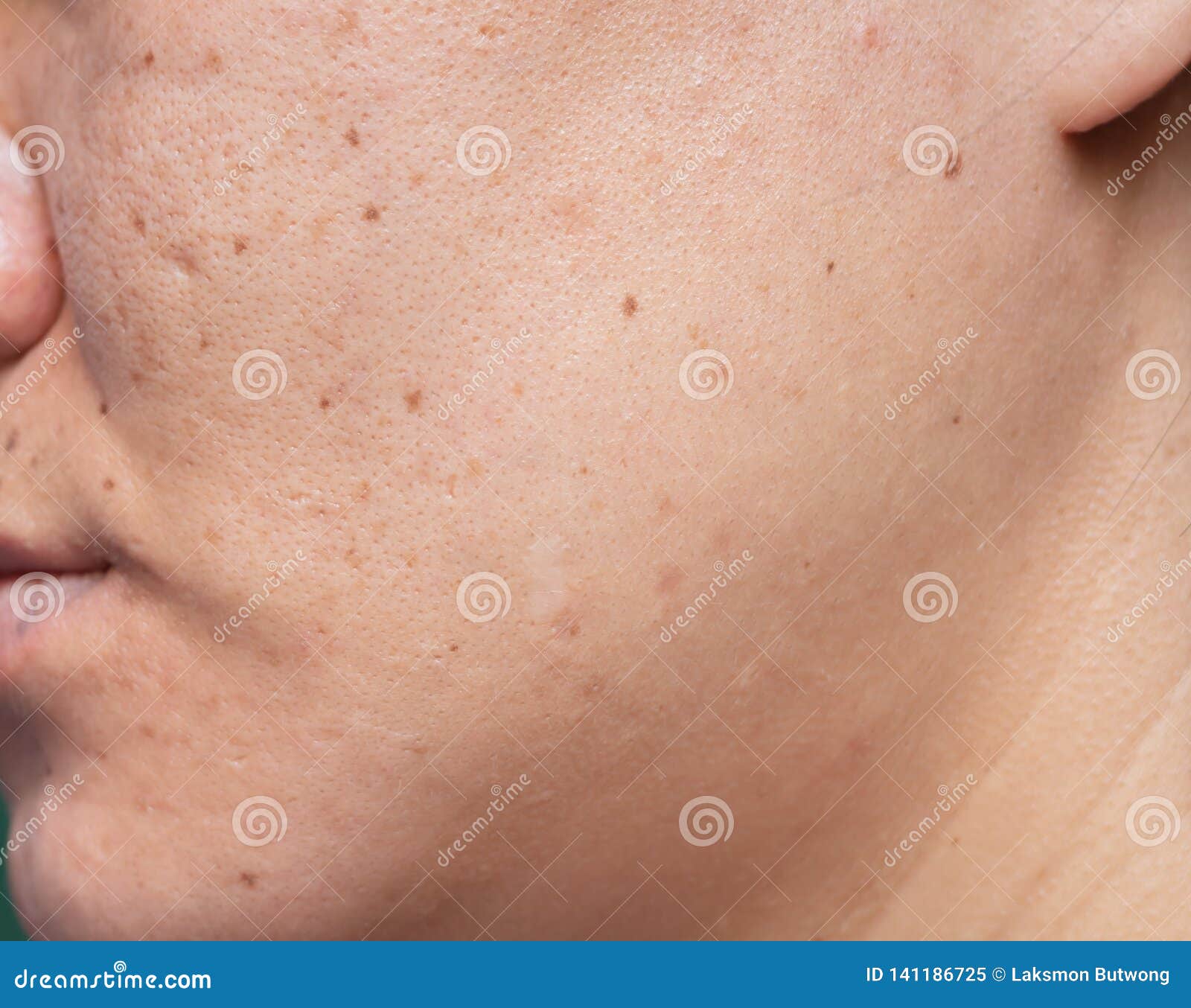 white acne scars on face