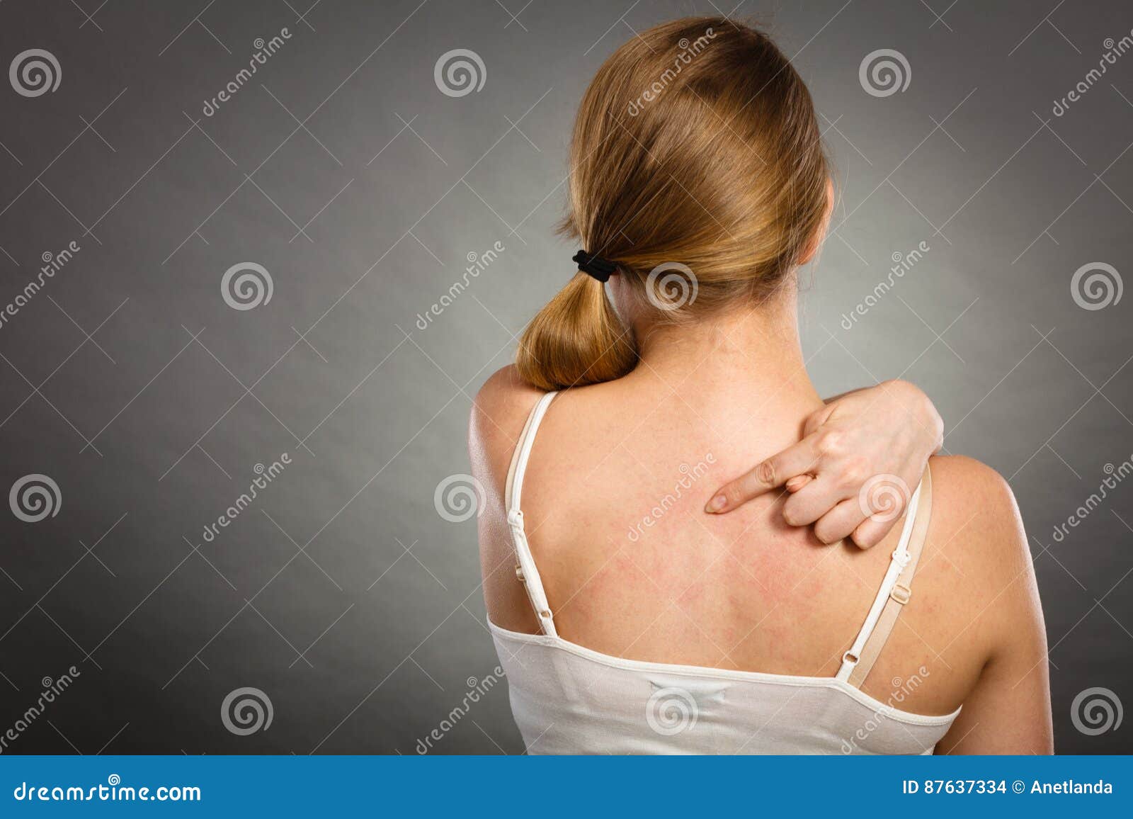 Woman Scratching Her Itchy Back with Allergy Rash Stock Photo - Image of  scratch, disease: 87637334