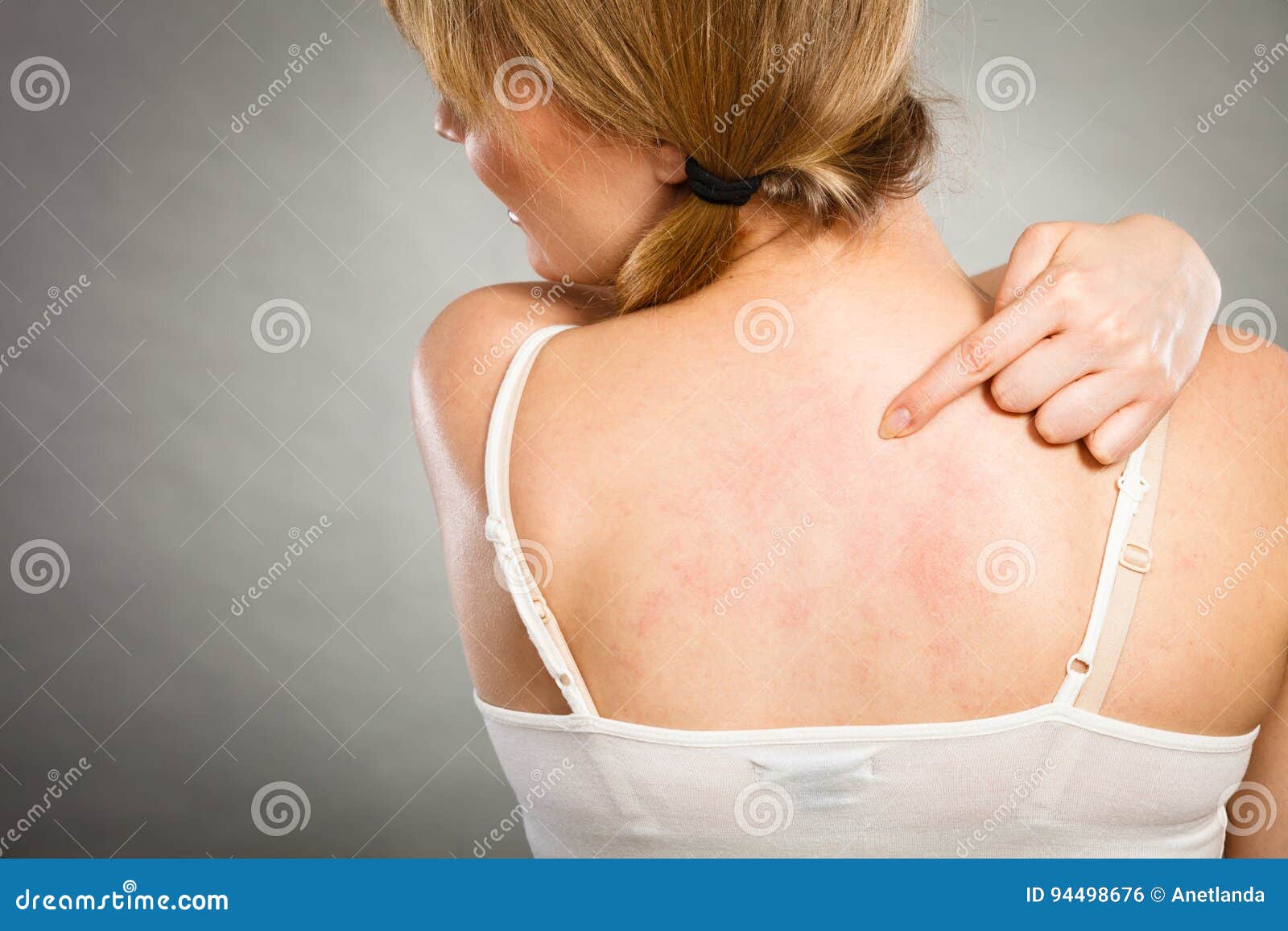 woman scratching her itchy back with allergy rash