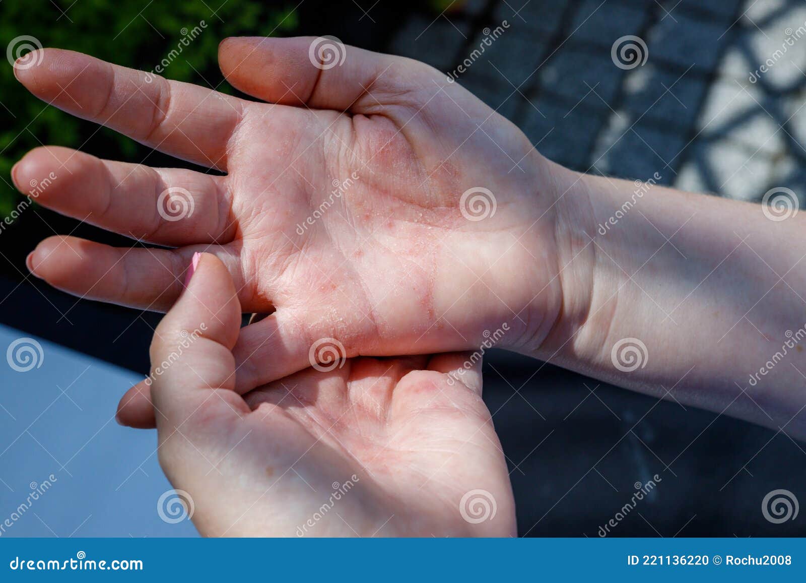 woman scratching itchy hand, concept, atopic dermatitis, red hands, dermatological problem