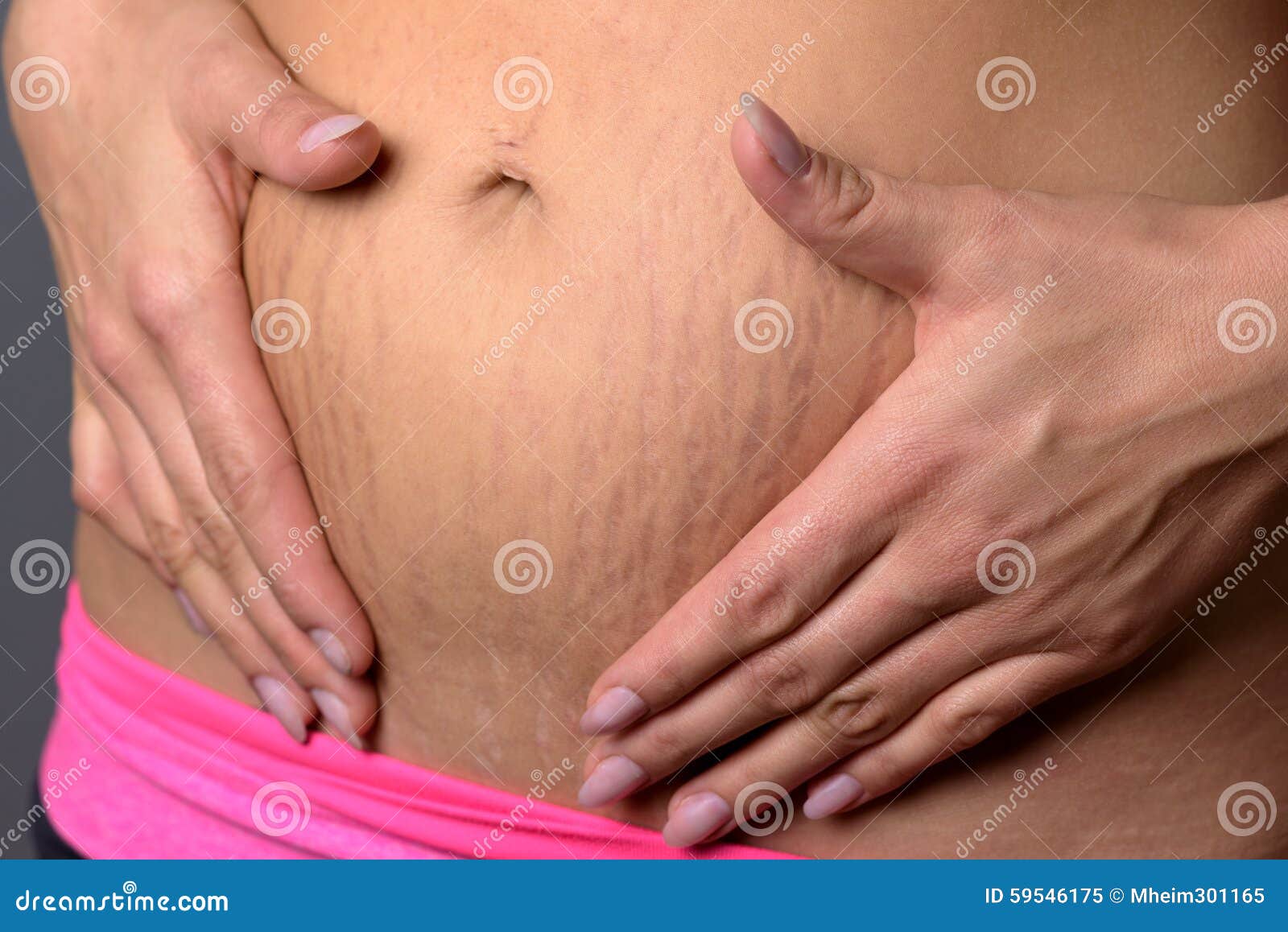 woman showing stretch marks on her lower abdomen