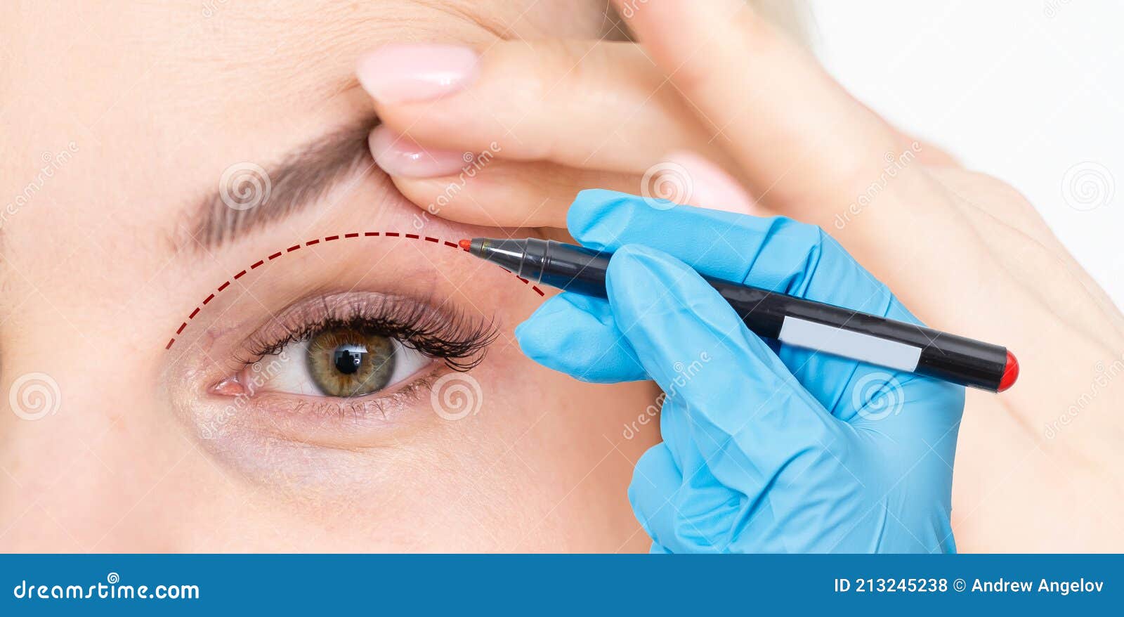 woman shows drooping eyelid for plastic surgery. doctor plastic surgeon marks with a felt-tip pen a marker for a