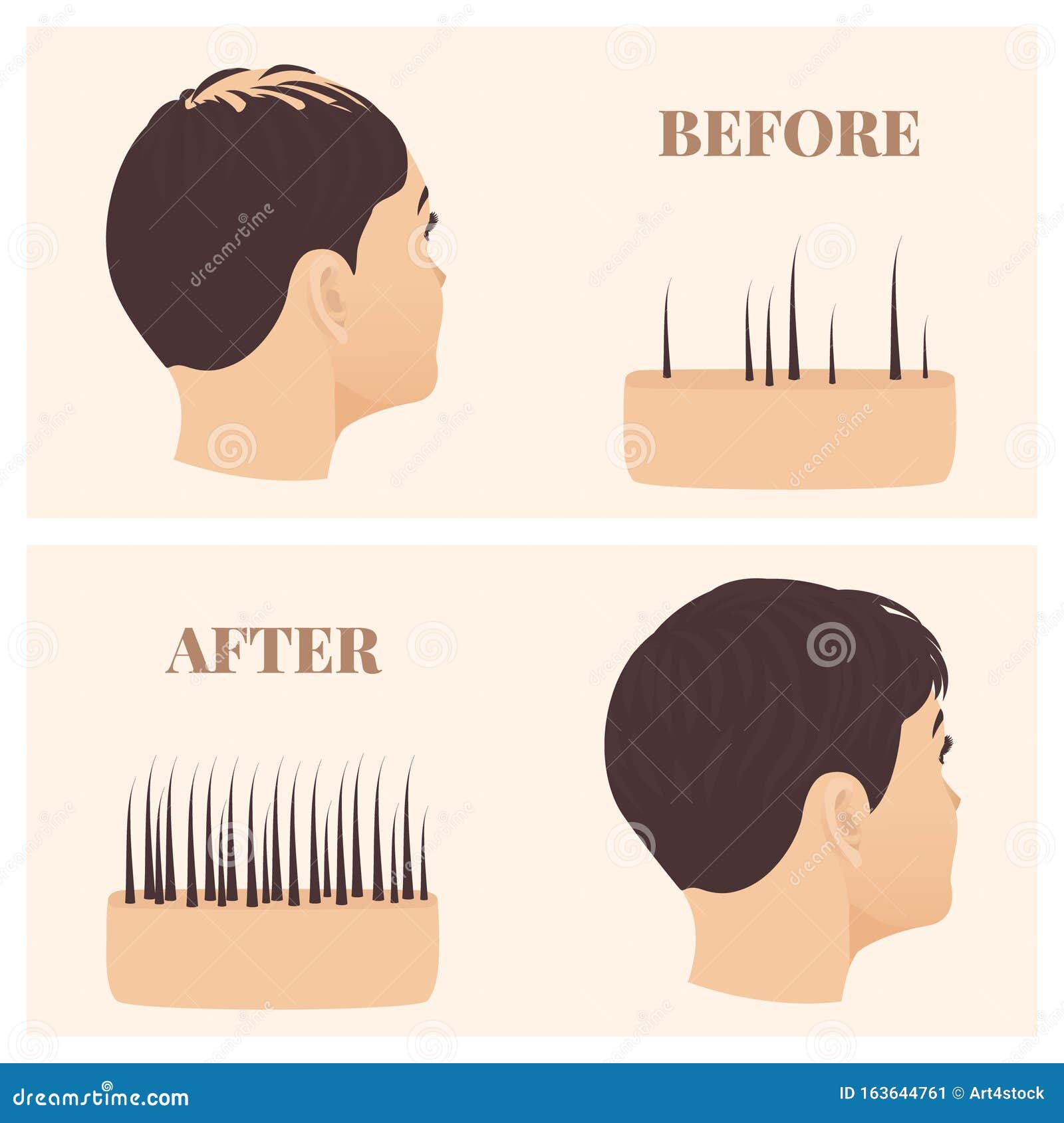 Woman in Side View before and after Hair Loss Treatment Stock Vector - Illustration of medical, character: 163644761 Woman in Side View before and after Hair Loss Treatment Stock Vector - Illustration of medical, character: 163644761