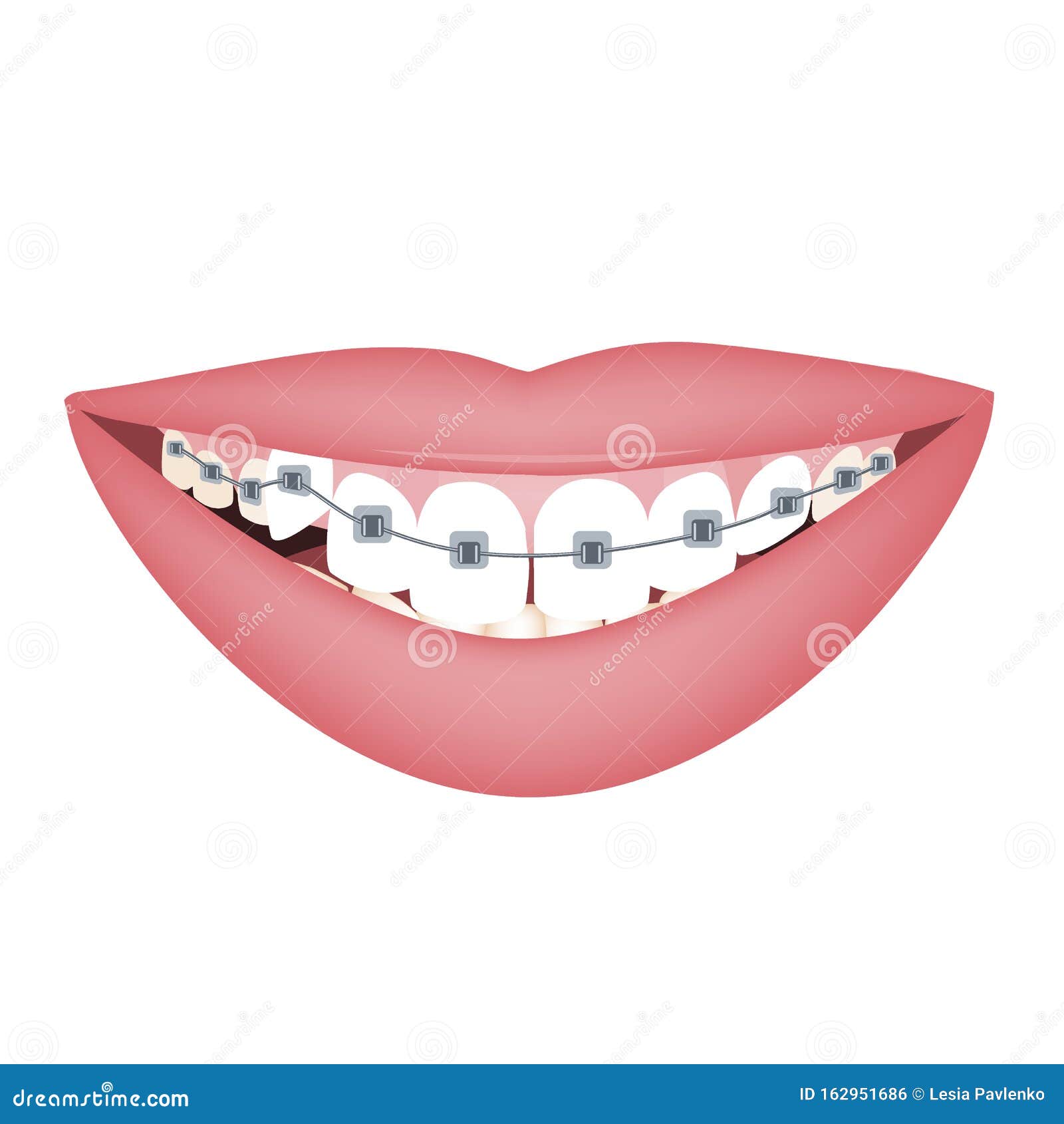 Download Woman Smile With Braces On Crooked Teeth. Vector ...