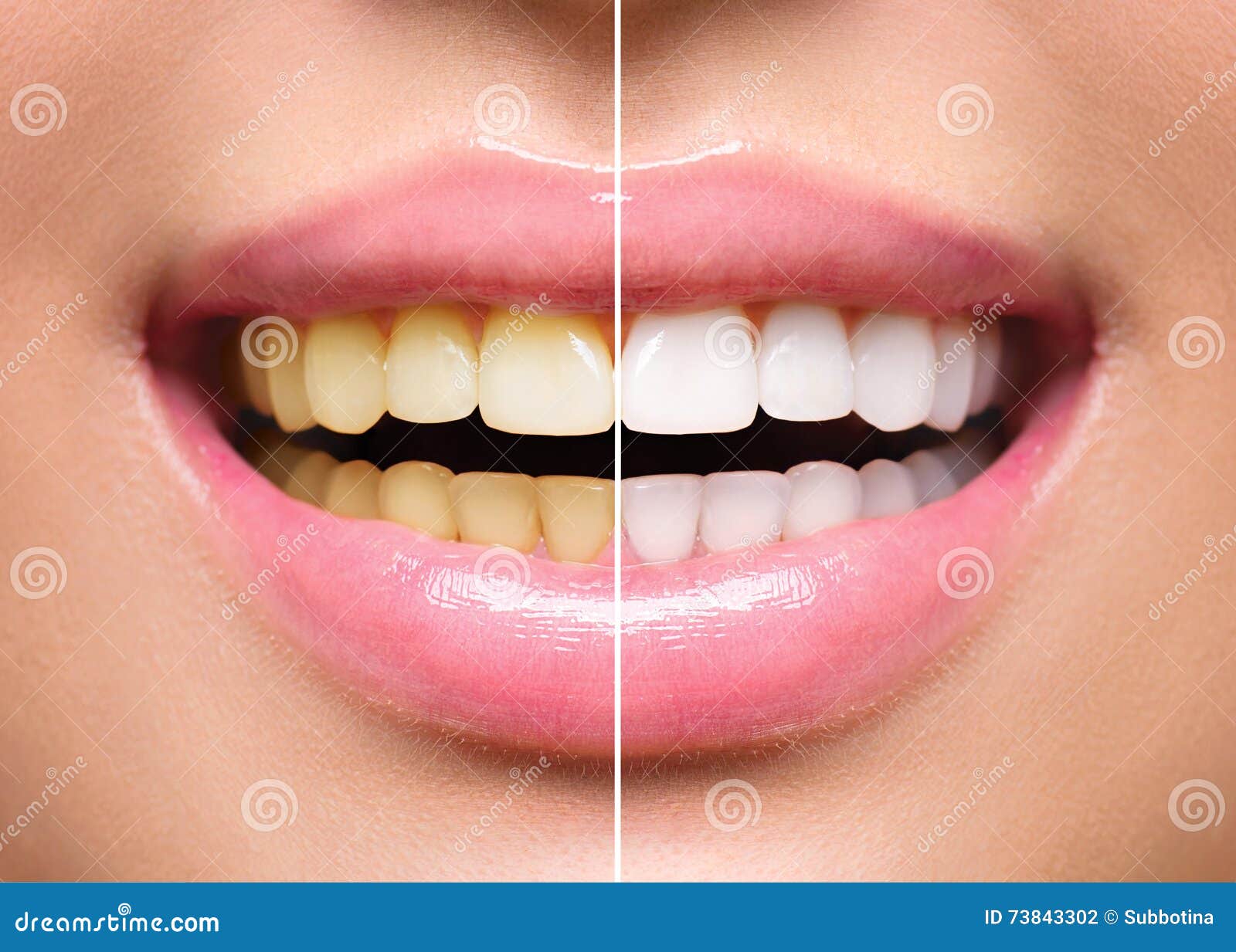 woman teeth before and after whitening