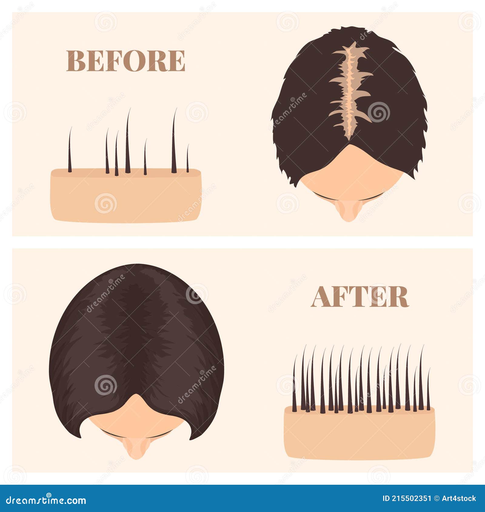 Woman in Top View before and after Hair Loss Treatment Stock Vector -  Illustration of face, grow: 215502351