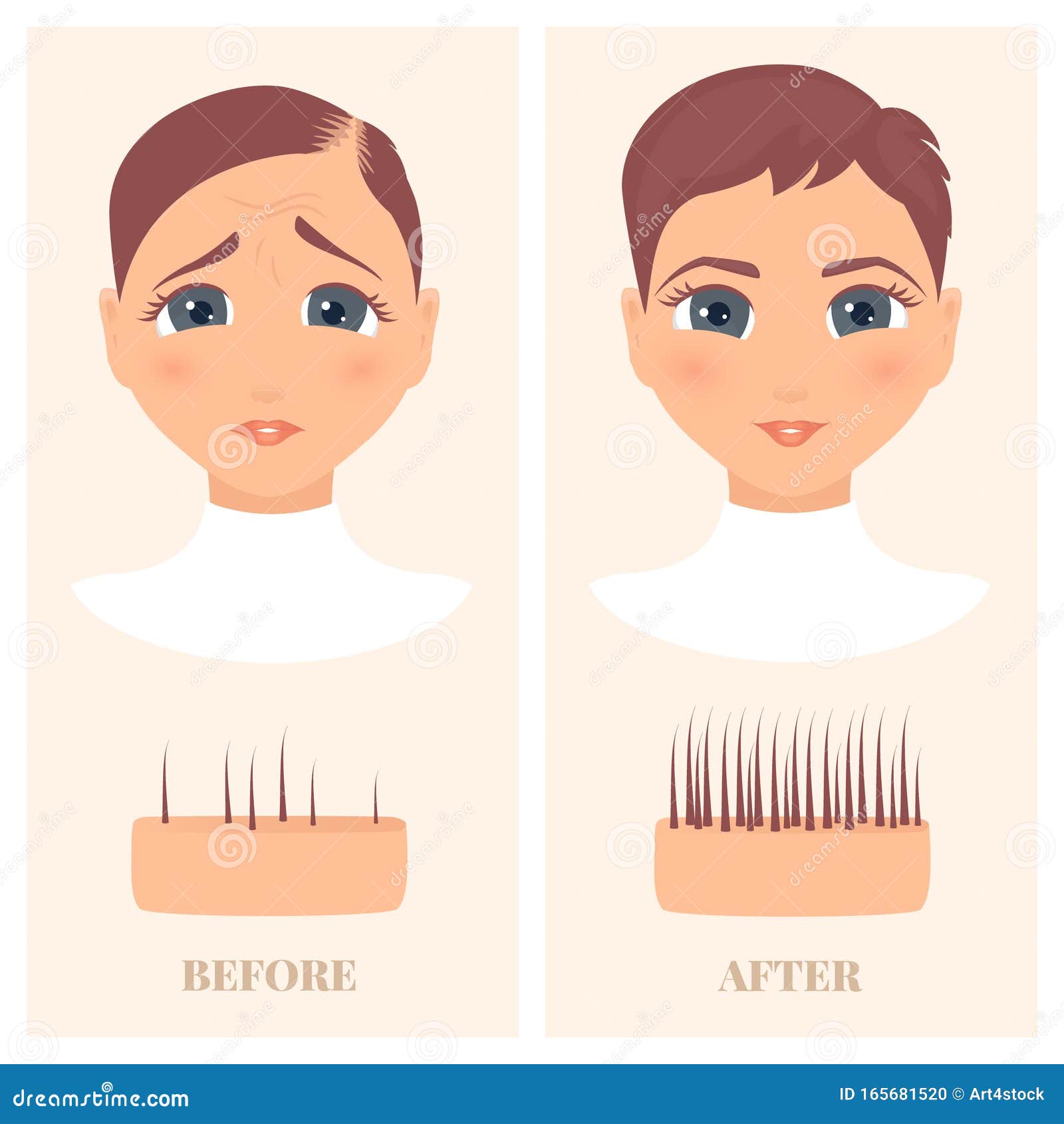 Woman before and after Hair Loss Treatment in Front View Stock Vector - Illustration of character, adult: 165681520 Woman before and after Hair Loss Treatment in Front View Stock Vector - Illustration of character, adult: 165681520