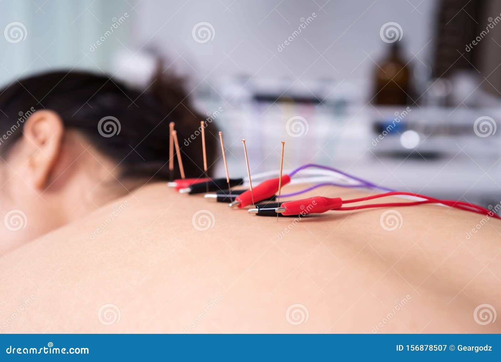 Woman Undergoing Acupuncture Treatment with Electrical Stimulator on