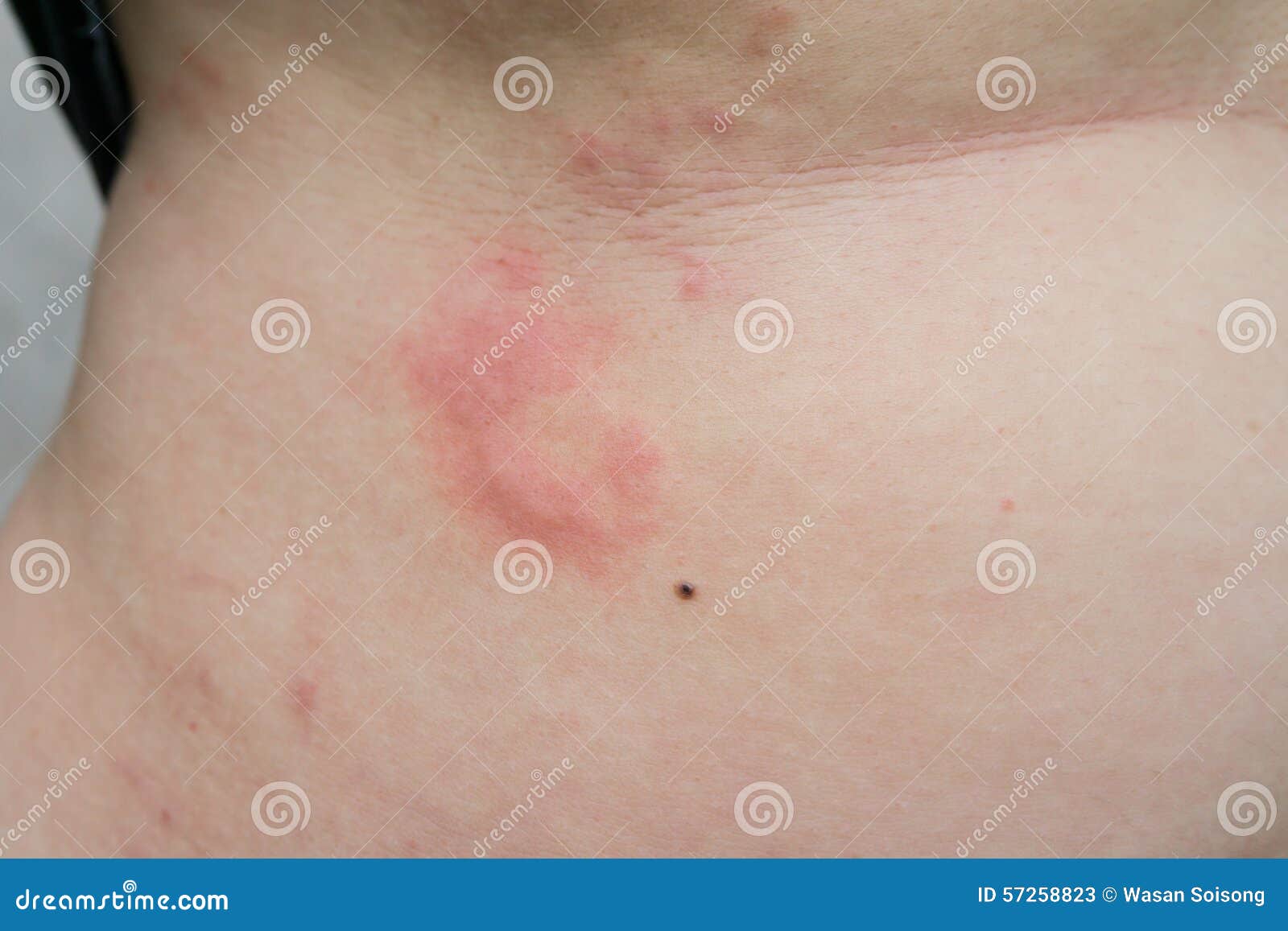 a woman is urticaria on belly