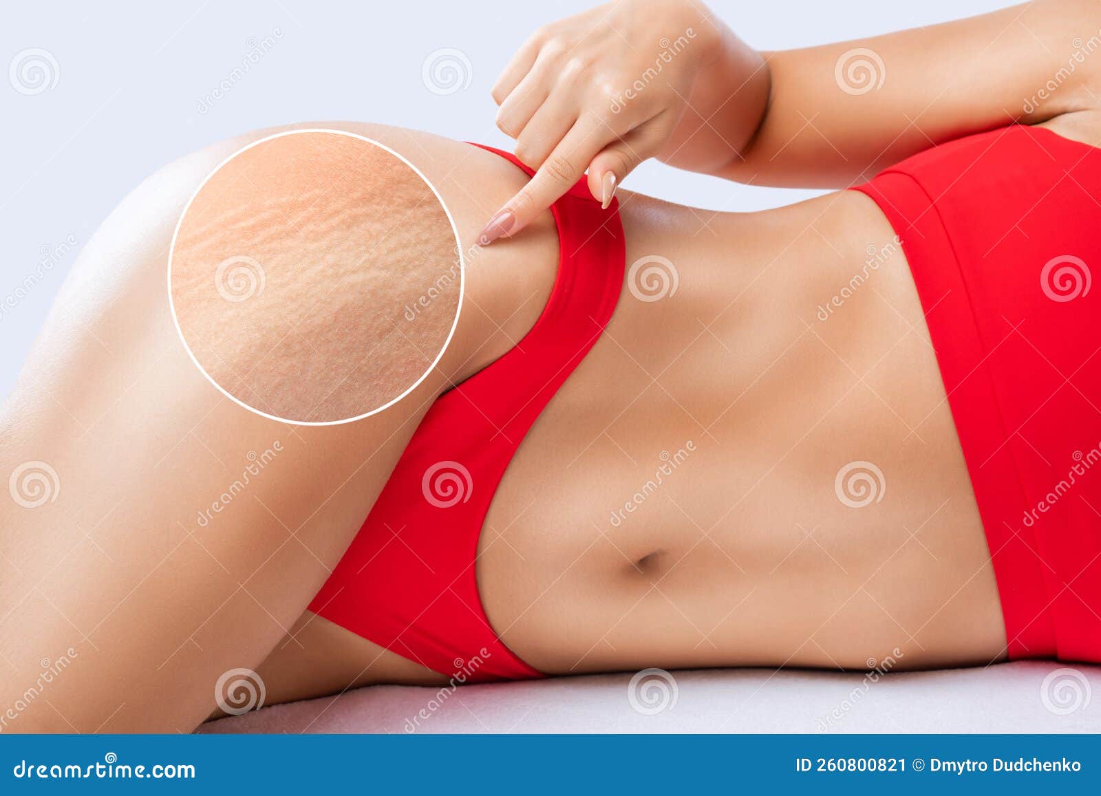 Woman grabbing skin on her flanks with black color crosses marking, Lose  weight and liposuction cellulite removal concept, Isolated on white  backgroun Stock Photo - Alamy