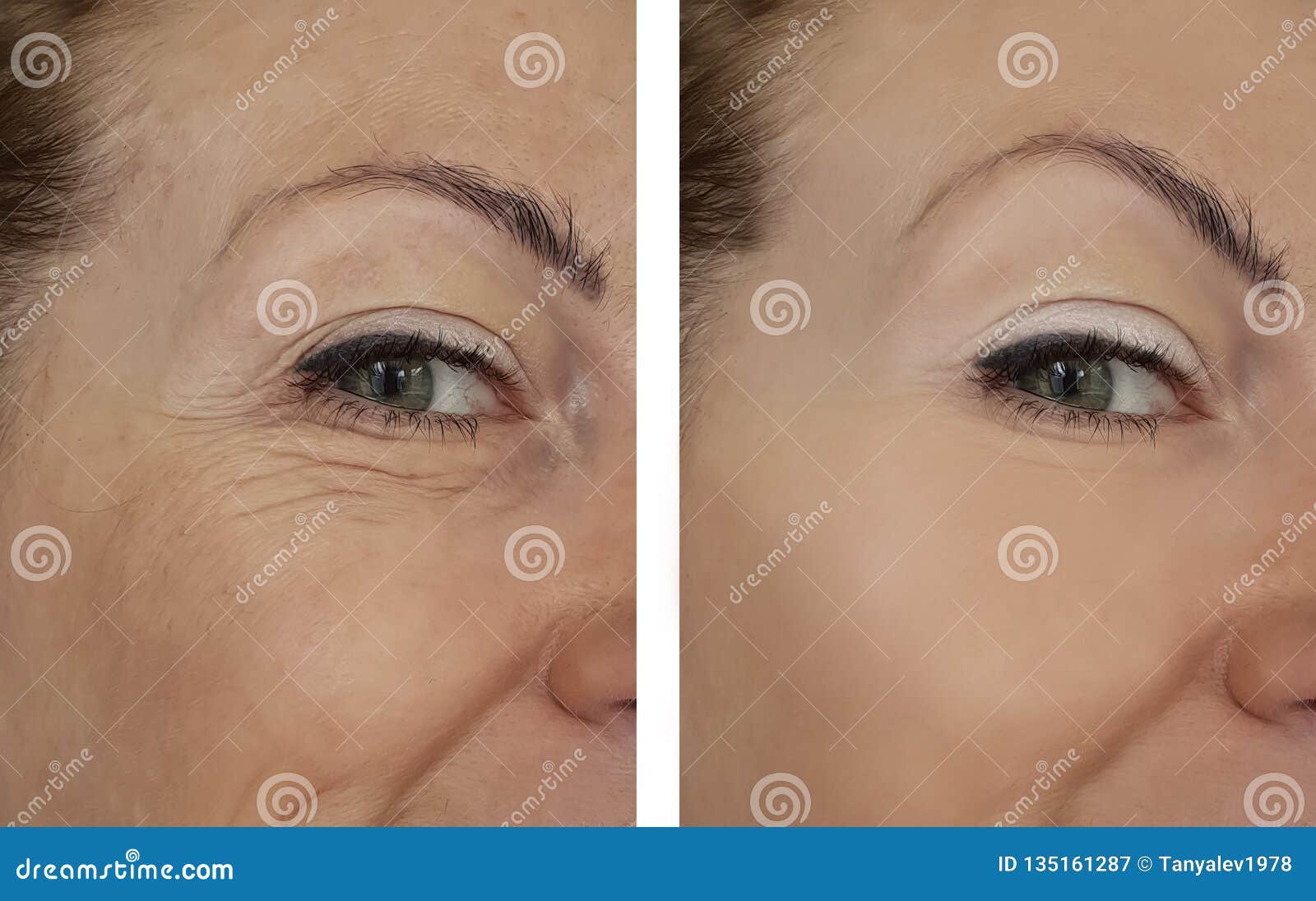 Woman Wrinkle Eyes before and after Procedures Stock Image Image of