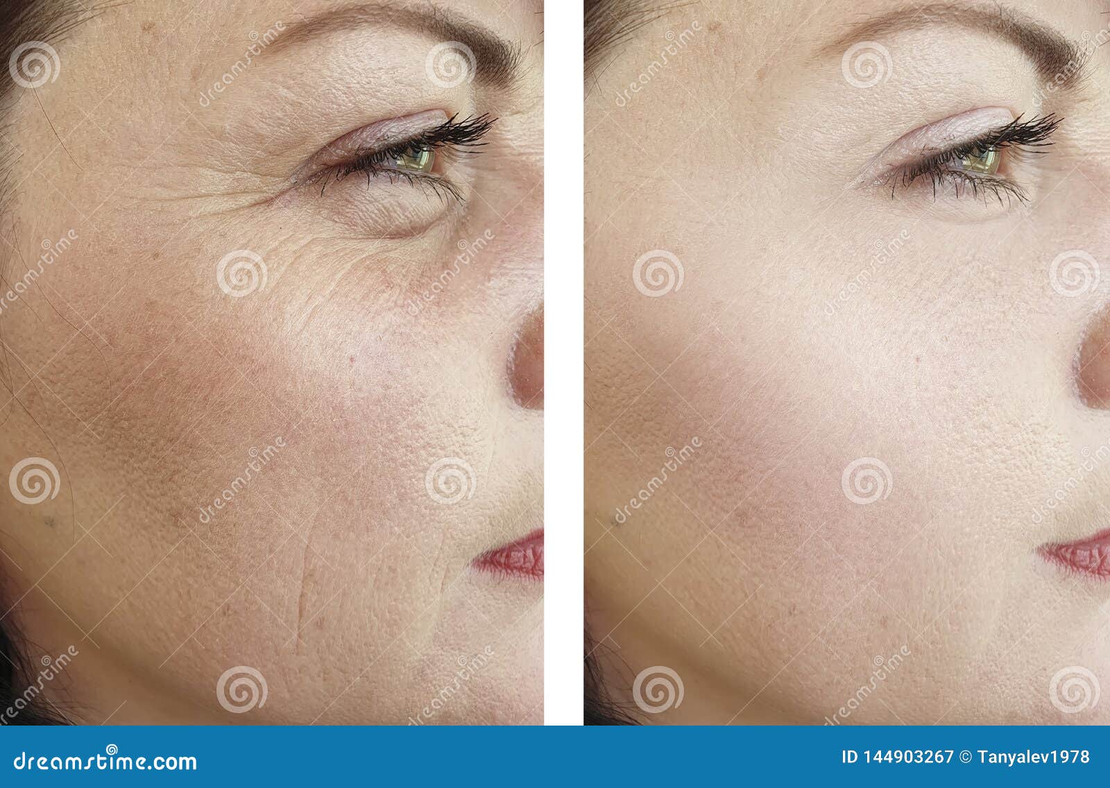 woman wrinkles face beautician effect therapydifference regeneration before and after treatments