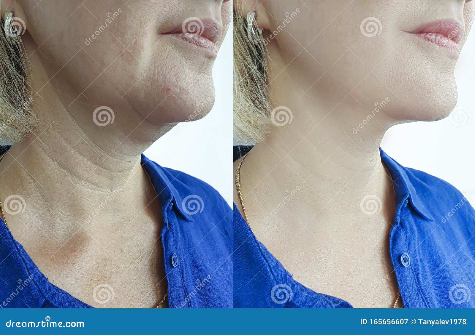 woman wrinkles face before  facelift collage after treatments procedure problem