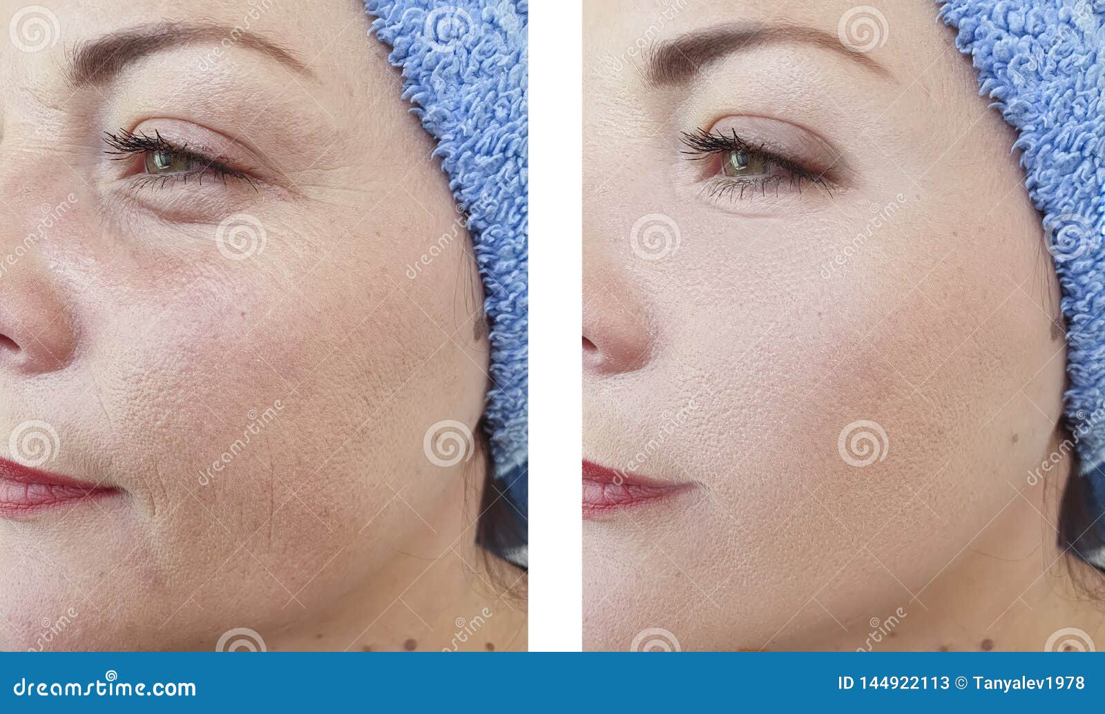 woman wrinkles face beautician difference before and after treatments