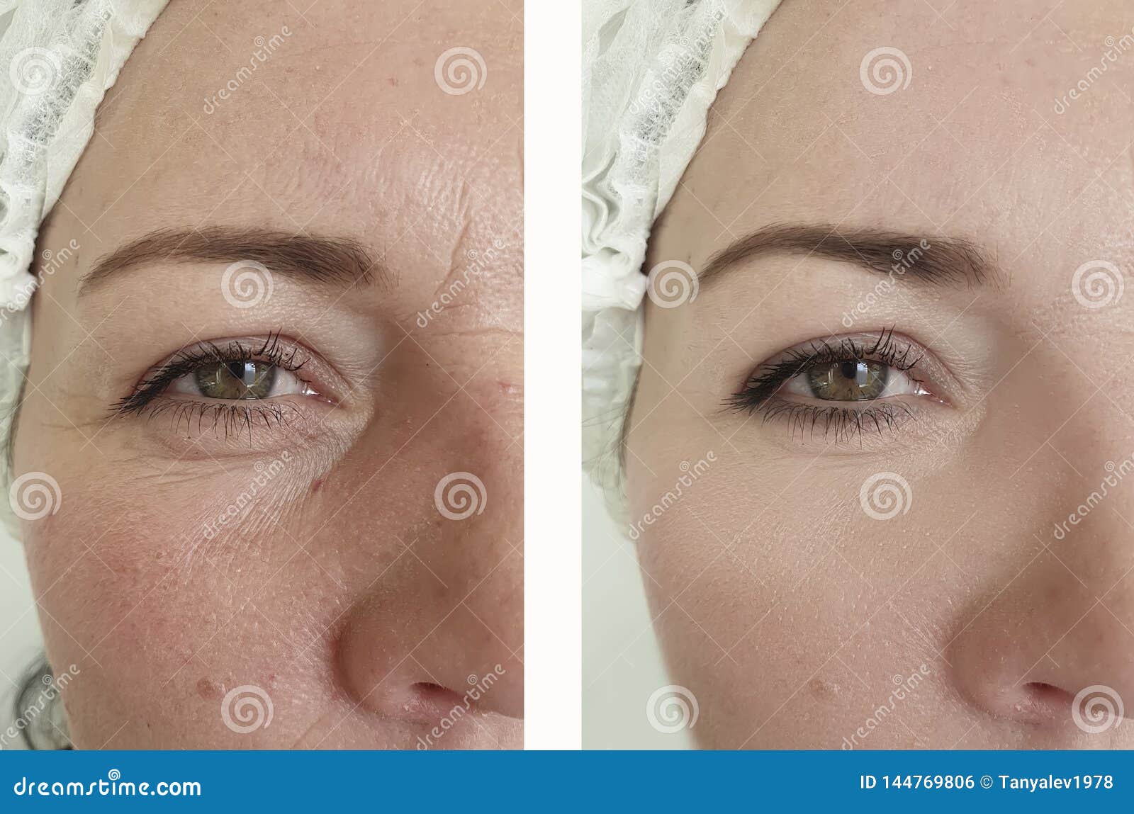 woman wrinkles before after oval effect mature  cosmetology difference lift antiaging procedures