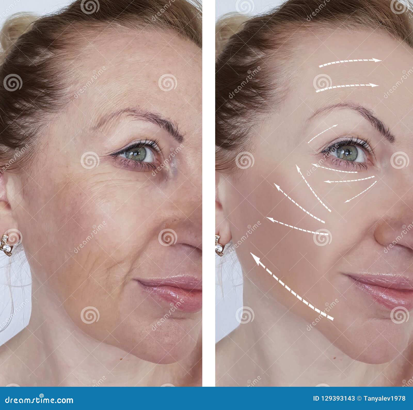 woman wrinkles skin difference antiaging contours before and after regeneration