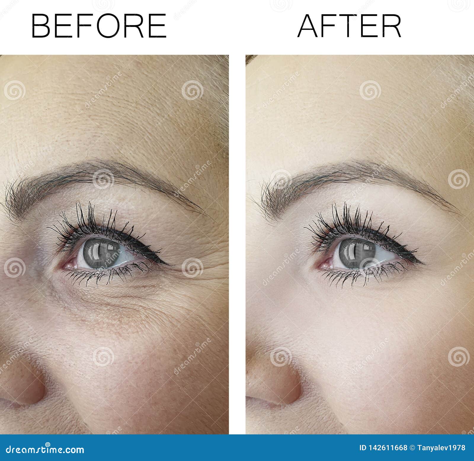tratamiento anti aging eyes)