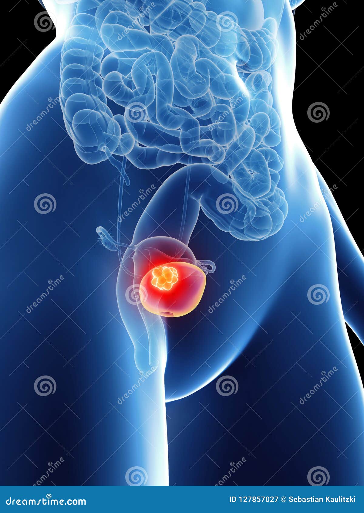 a womans bladder cancer