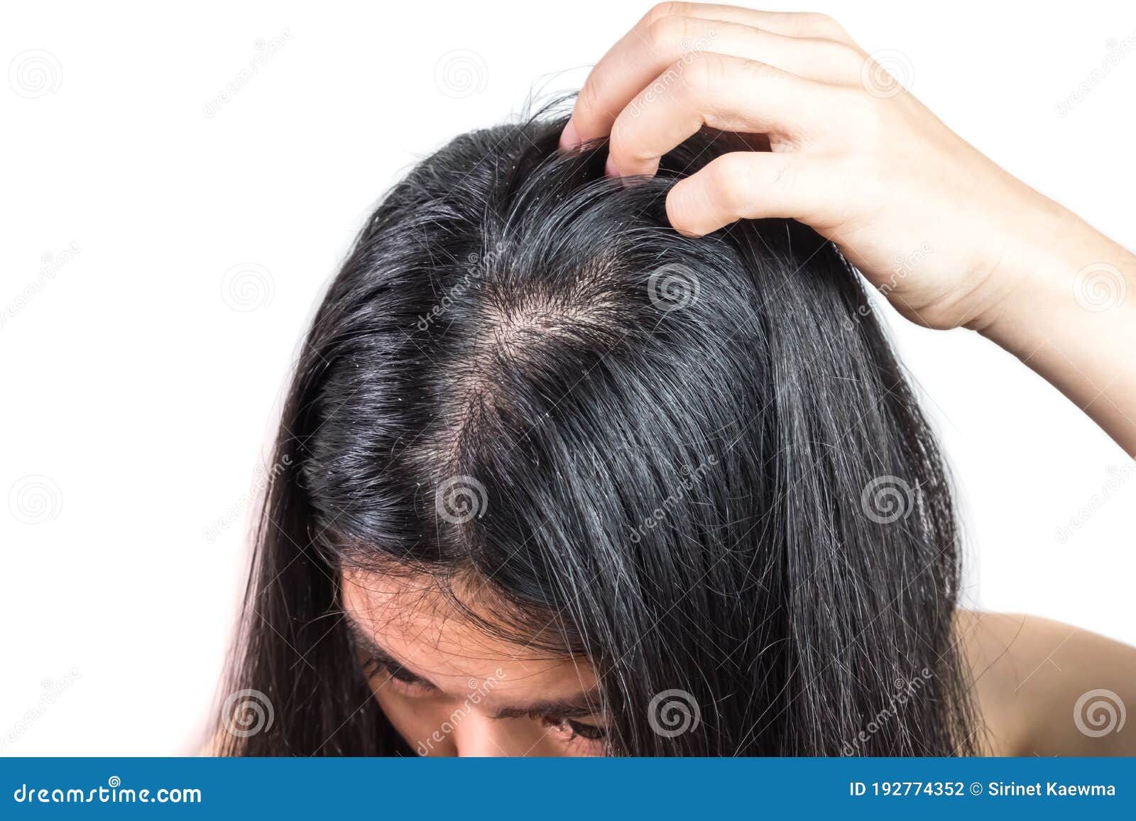 Women Head with Dandruff Caused by the Problem of Dirty. or Caused by Skin  Disease or Seborrheic Dermatitis Stock Photo - Image of care, girl:  192774352