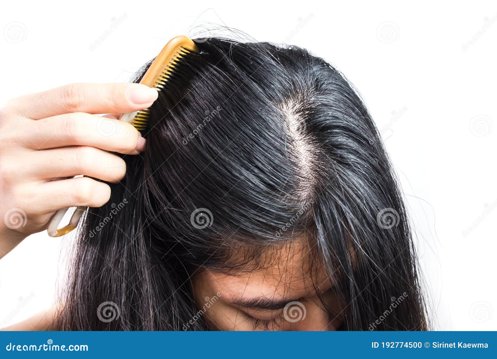 Women Head with Dandruff Caused by the Problem of Dirty. or Caused by Skin Disease or Seborrheic Dermatitis Stock Photo - Image of magnifying, hair: 192774500 Women Head with Dandruff Caused by the Problem of Dirty. or Caused by Skin Disease or Seborrheic Dermatitis Stock Photo - Image of magnifying, hair: 192774500