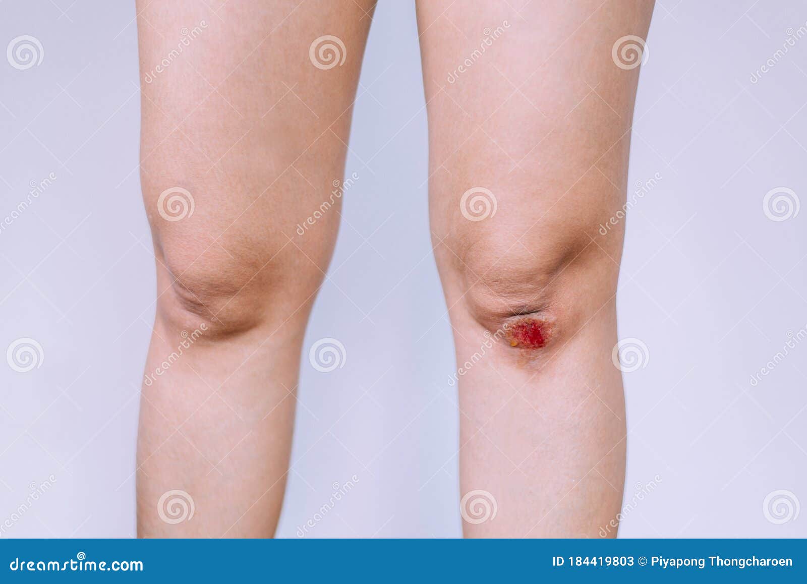 Bulion hamei varicoza. Picioarele varicoase în asistena medicala