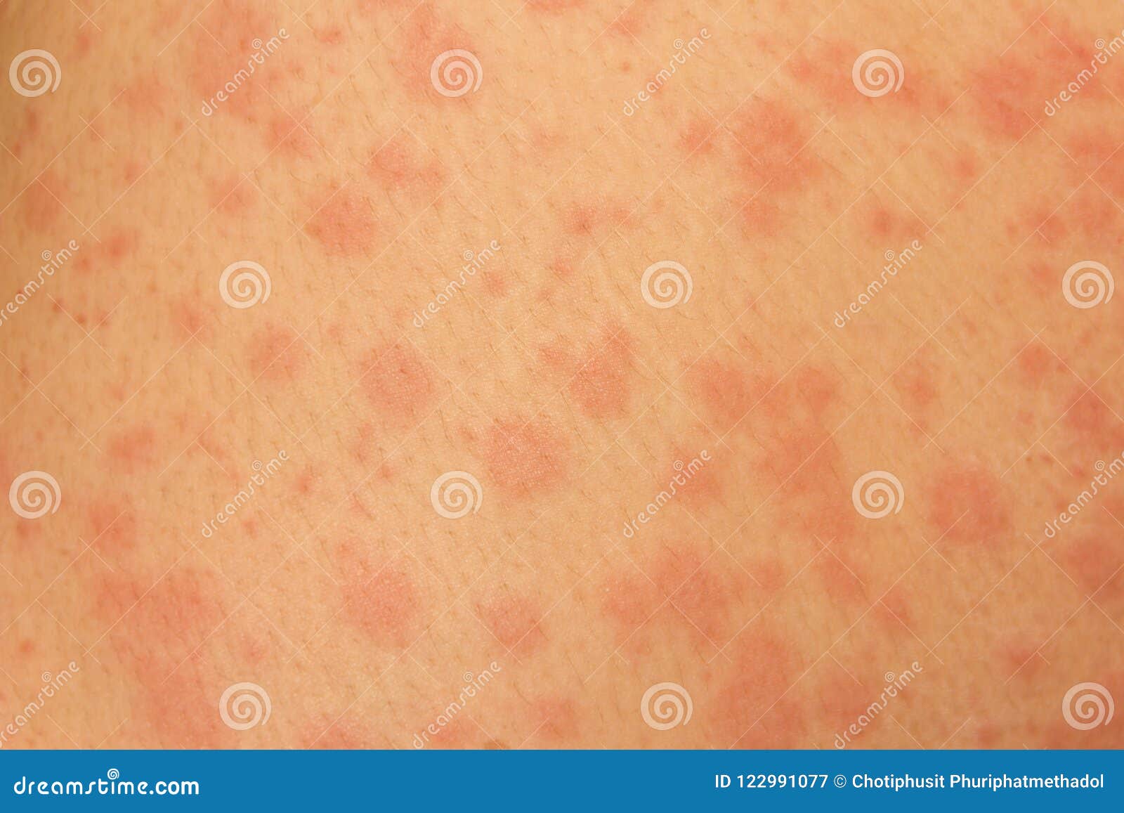 Women with Symptoms of Itchy Urticaria Stock Image Image of