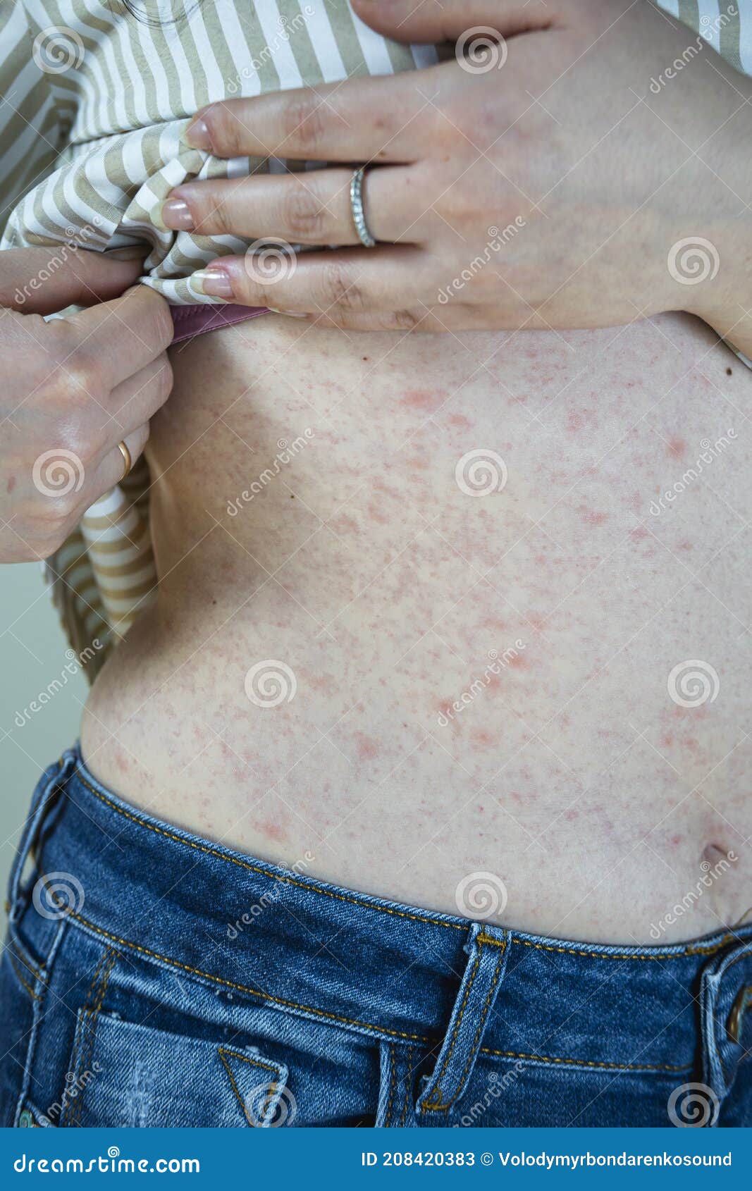 Women With Symptoms Of Itchy Urticaria Or Allergic Reaction On The Skin