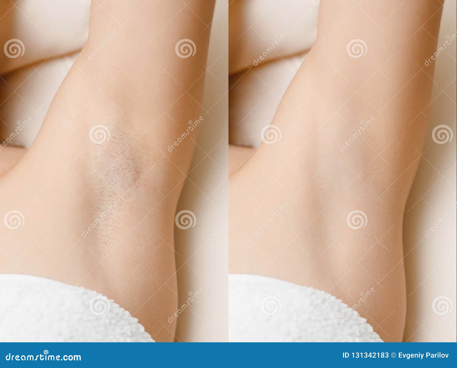 women underarm hair removal before and after