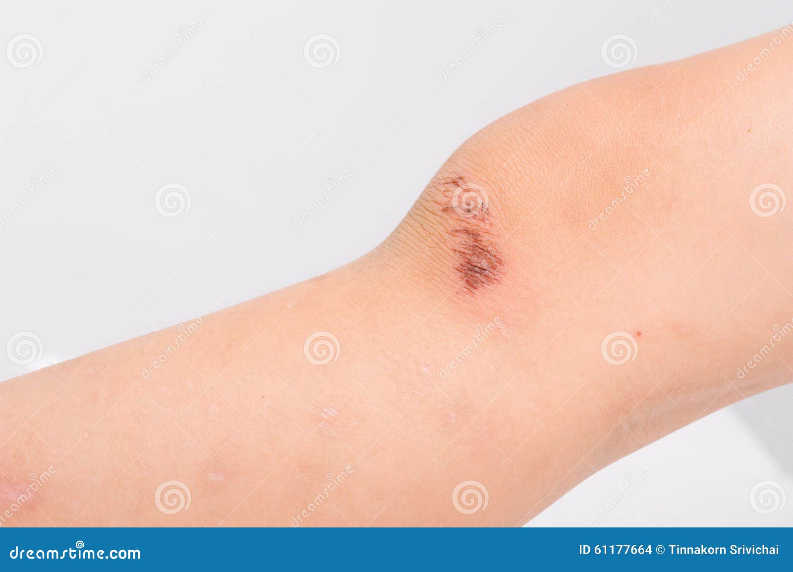 Wound On Child Knee From Accident Become Dry Stock Photo Image Of