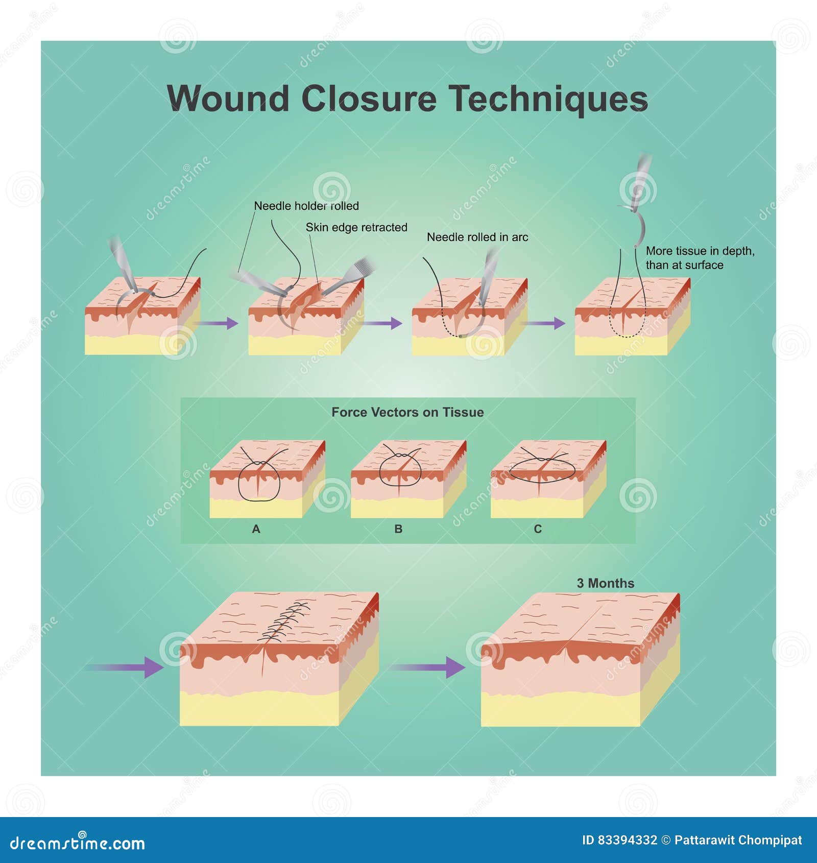 Wound Closure Techniques