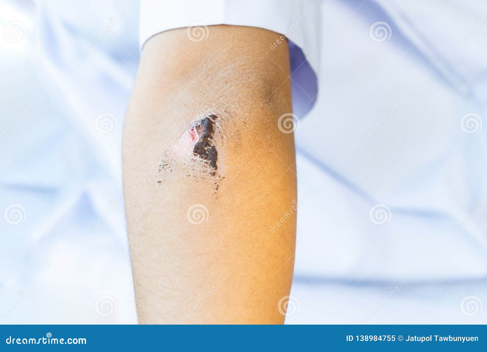 Wound Have Scab on the Elbow of the Child Stock Image Image of lesion