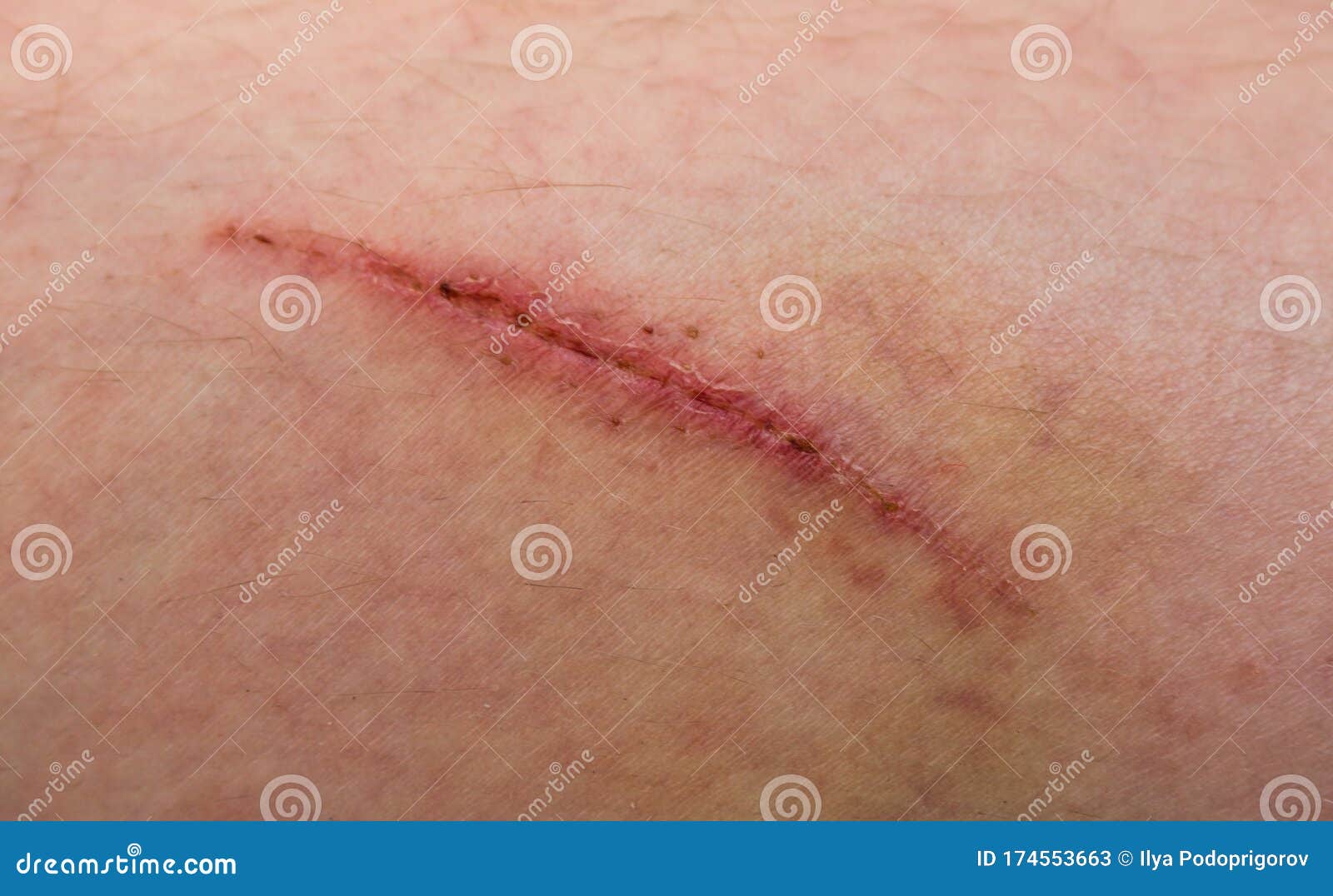 A Wound on the Human Body, Suture Old, Deep Cut, Scar Closeup