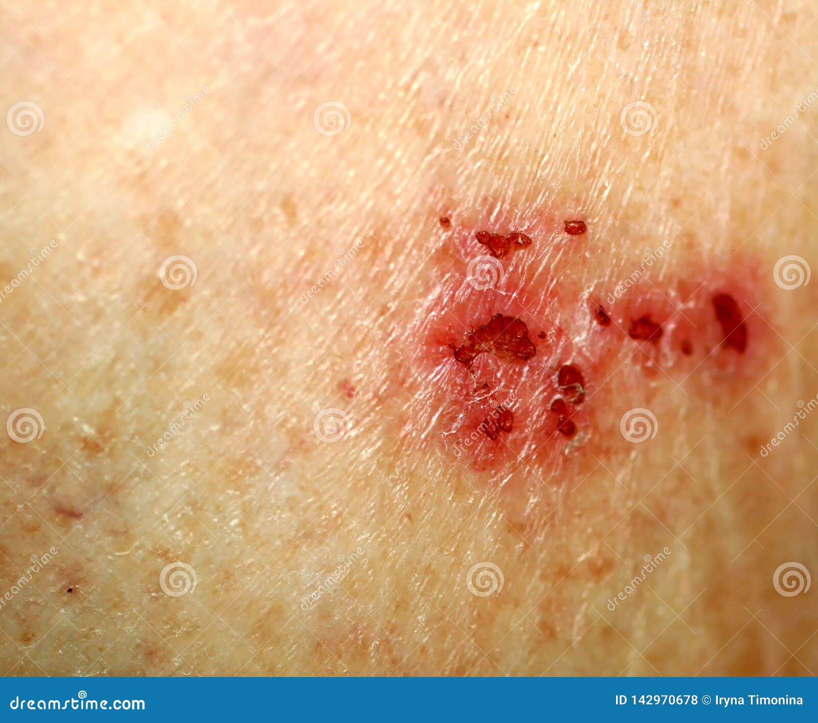 Wound on the Skin. Psoriasis, Dermatitis, Eczema. Stock Photo Image