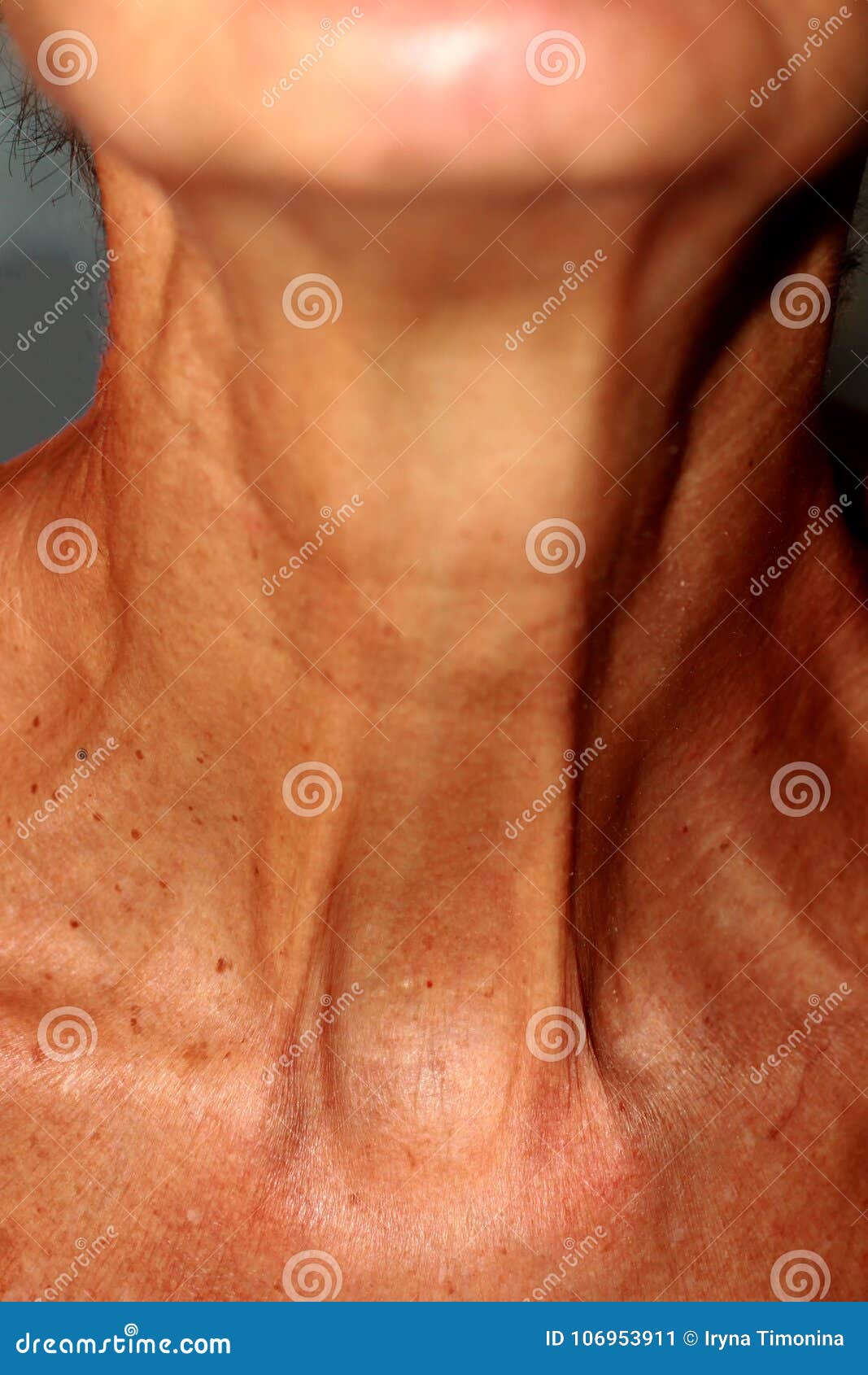 Wrinkles on the Neck. Flabby Skin on the Neck. Stock Image Image of