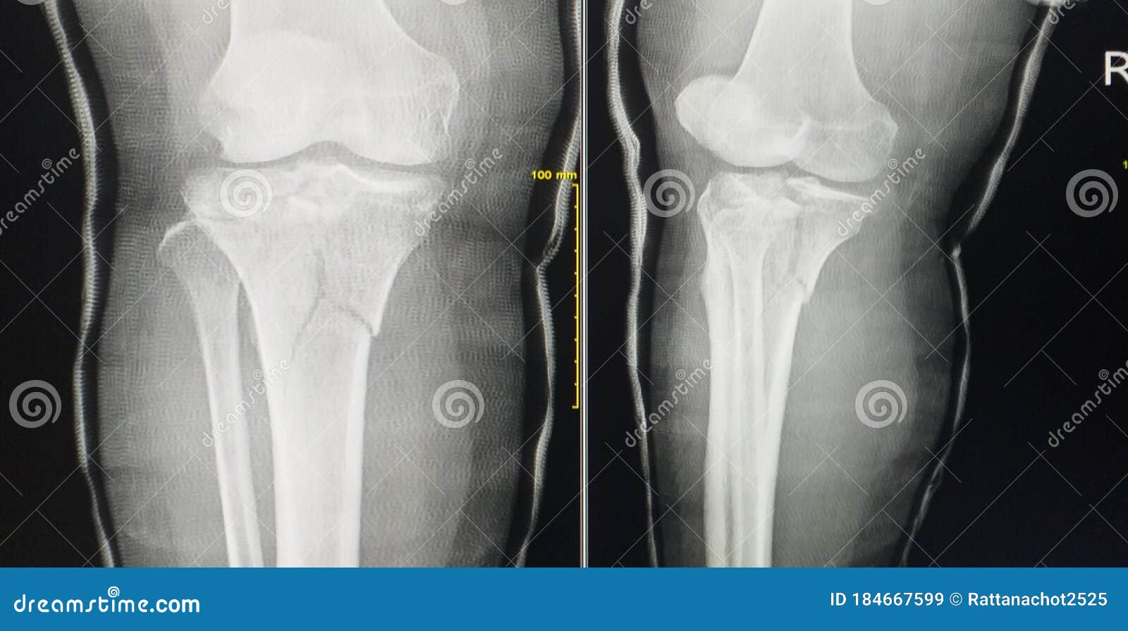 X射线右腿ap 侧向后铸骨折近端胫骨通过关节没有位错 骨破坏 正常关节空间 库存图片 图片包括有腓骨 适应