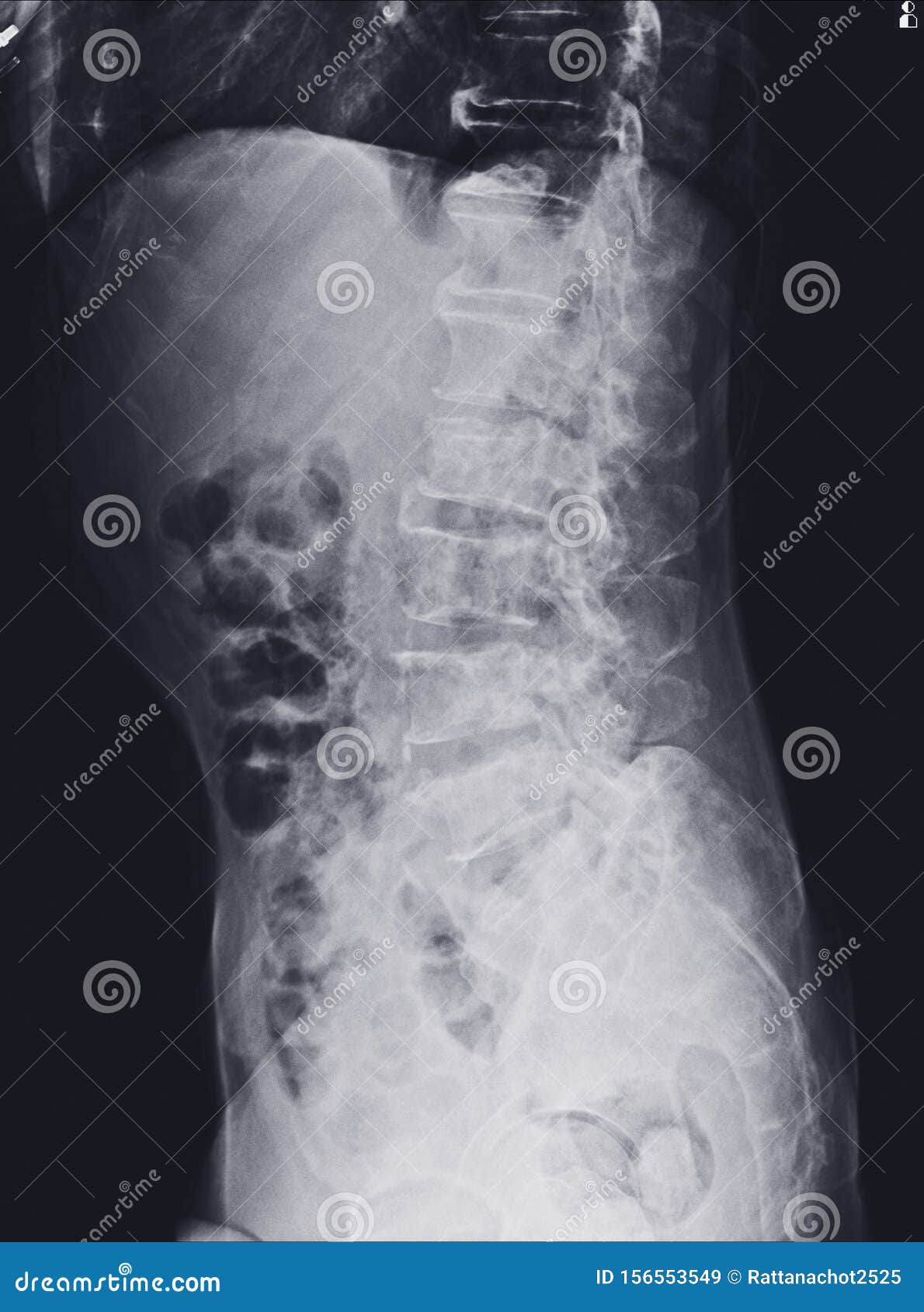 X射线腰椎在髂骨中发现多发高密度和低密度骨损伤库存图片 图片包括有 X射线腰椎在髂骨中发现多发高密度和低密度骨损伤库存图片 图片包括有