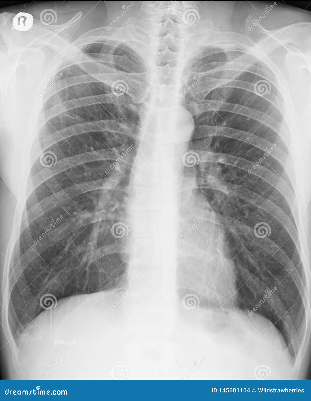 Chest X Ray Posteroanterior View Two Years After Spontaneous Pneumothorax 库存照片 图片包括有 Chest X Ray Posteroanterior View Two Years After Spontaneous Pneumothorax 库存照片 图片包括有