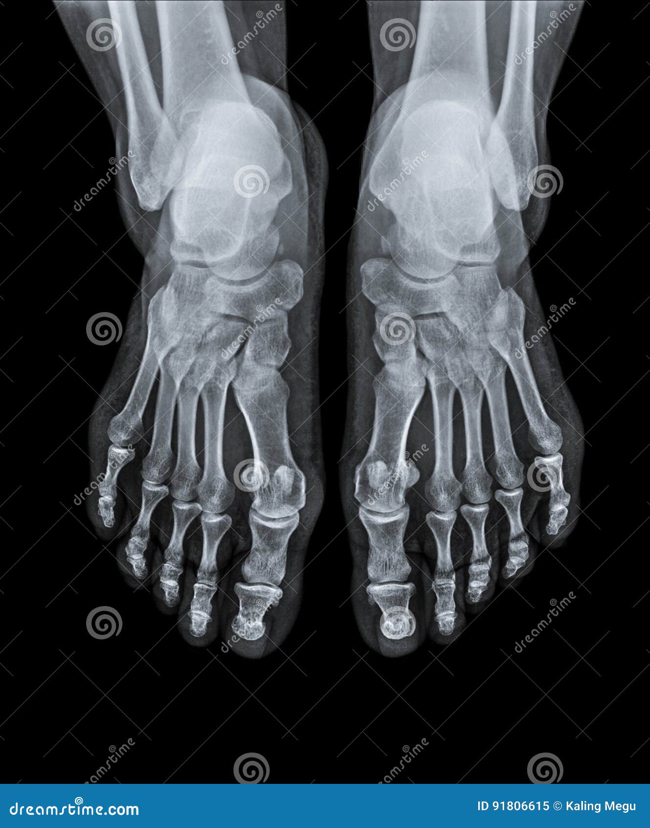 X Ray of Ankle Joint Front View. Stock Image Image of imaging, health
