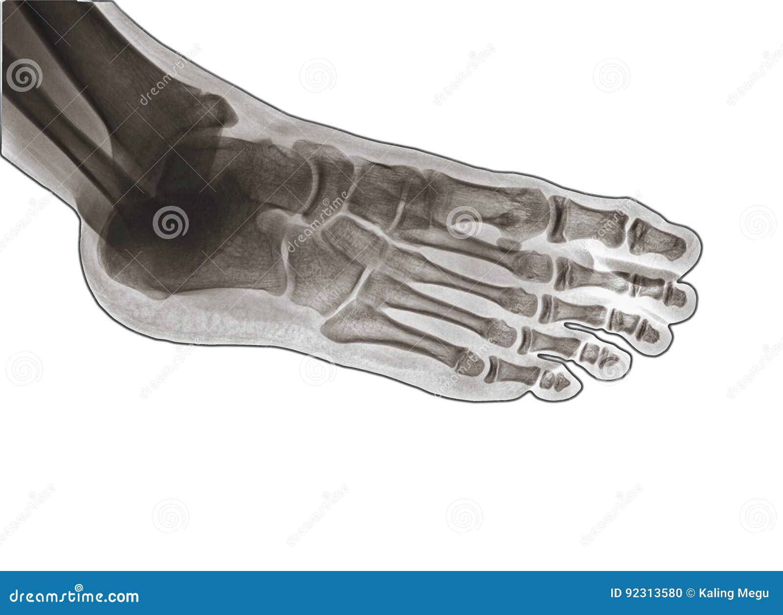 X Ray of Ankle Joint Side View. Stock Photo Image of imaging, pelvis