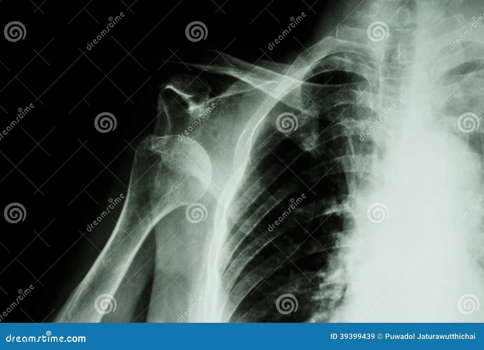 x-ray anterior shoulder dislocation