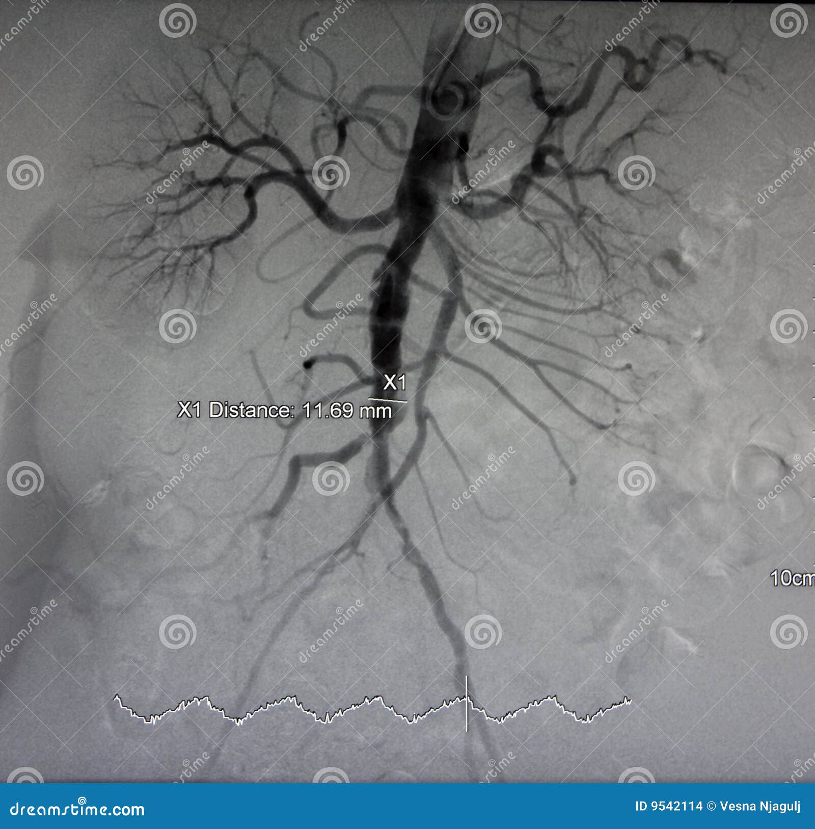 x-ray of aorta, abdominal vessels