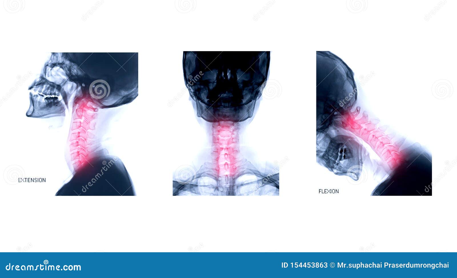 C-Spine Extension on Box. Xray extension