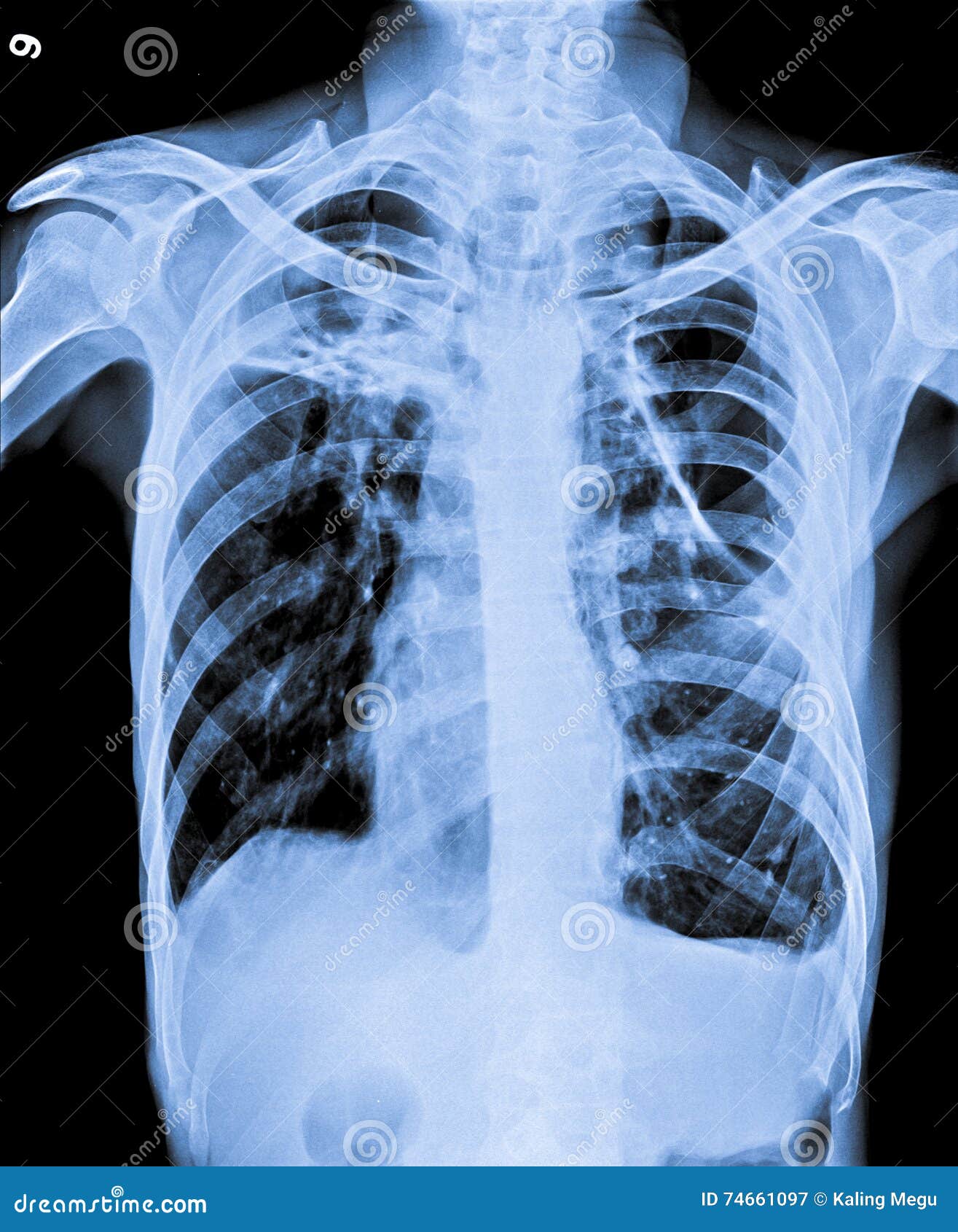 X Ray of Chest with Bands in Left Lung Stock Image Image of operation