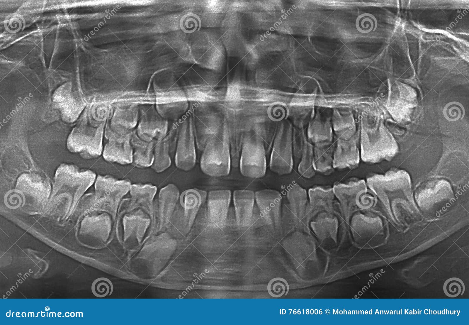 Xray Of Baby Teeth