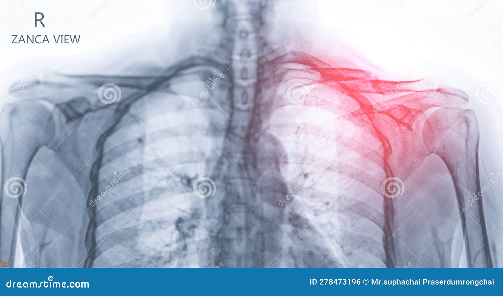Xray of Clavicle Bone Showing Fracture of Clavicle Bone Stock Photo