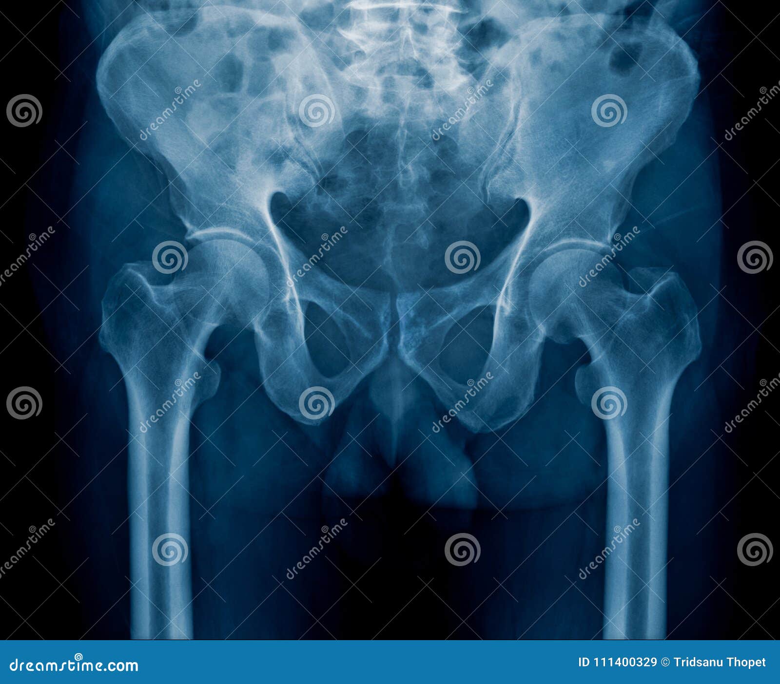 X-ray close up pelvic stock image. Image of bones, femur - 111400329