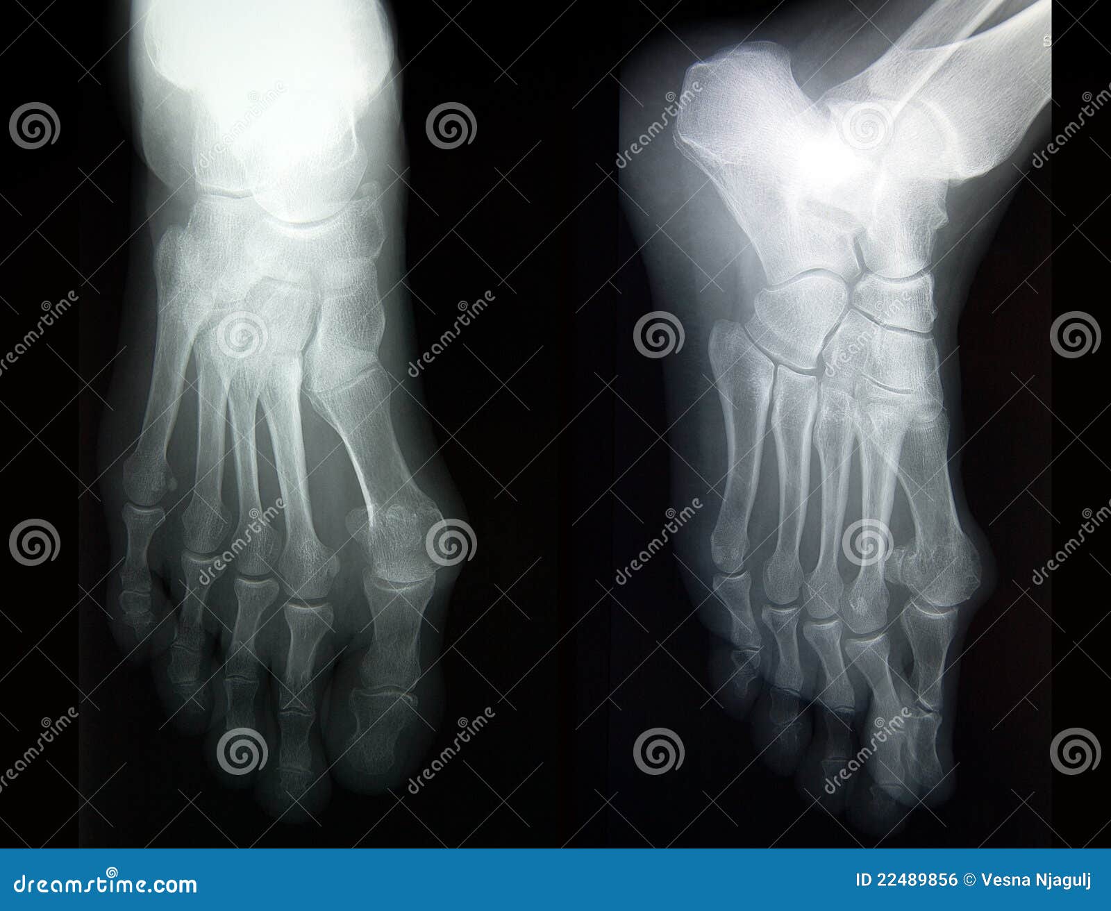 Plain Film Xray, Radiography, of Complete Foot in Two Projections