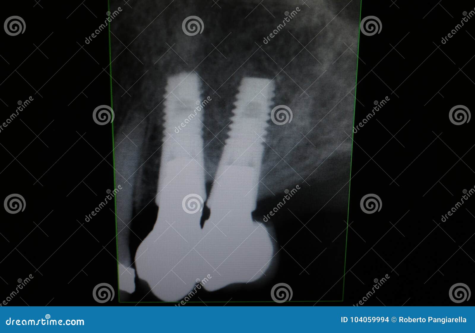 Xray dental implants stock photo. Image of film, care 104059994