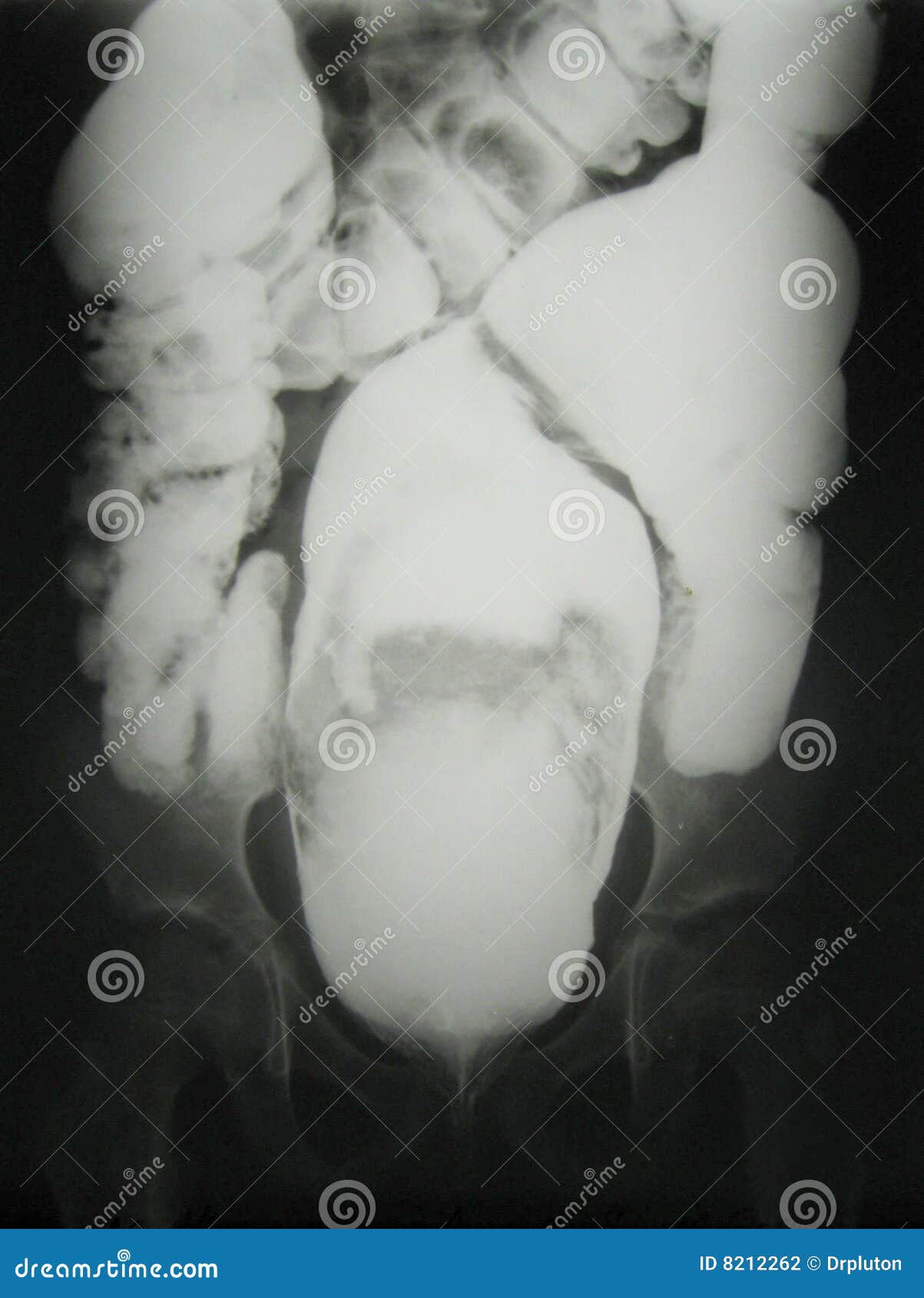 x-ray diagnostics/bowel